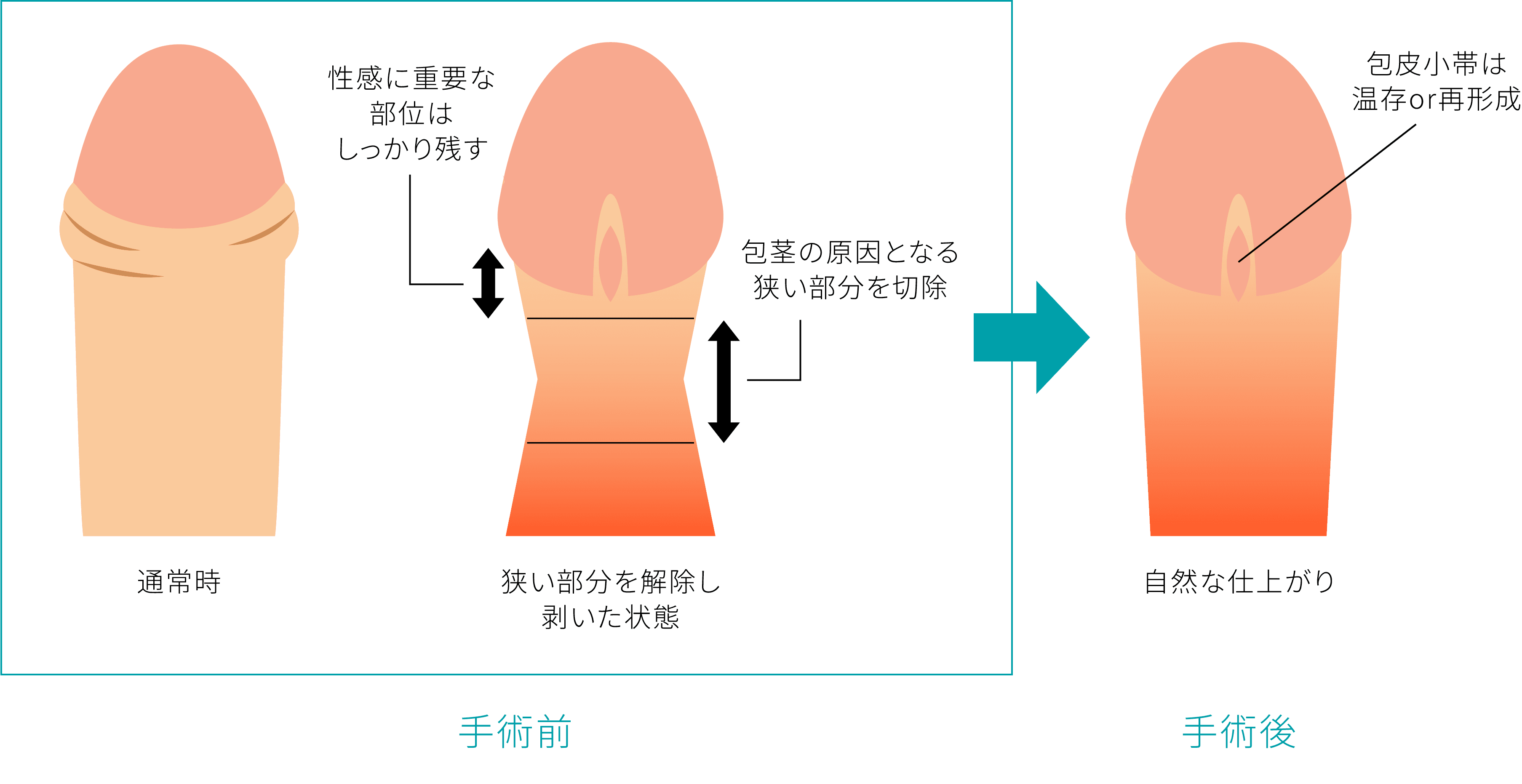 亀頭下環状切開法のイメージ