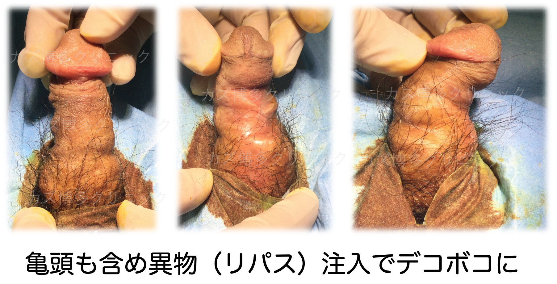 巨 大 な プ ラ グ.拳.裂 け 目