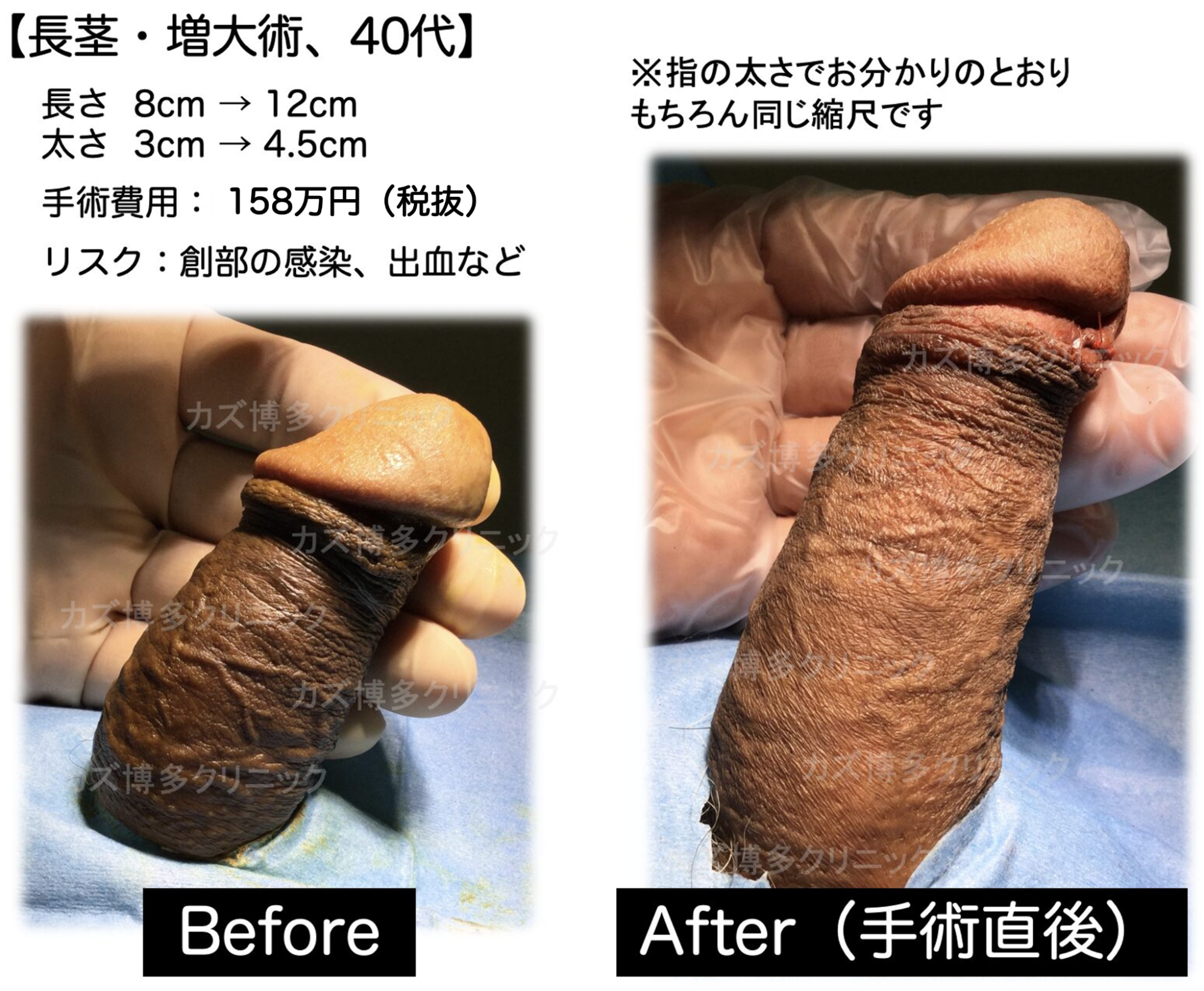 長茎手術によってサイズアップ（4cm）の症例