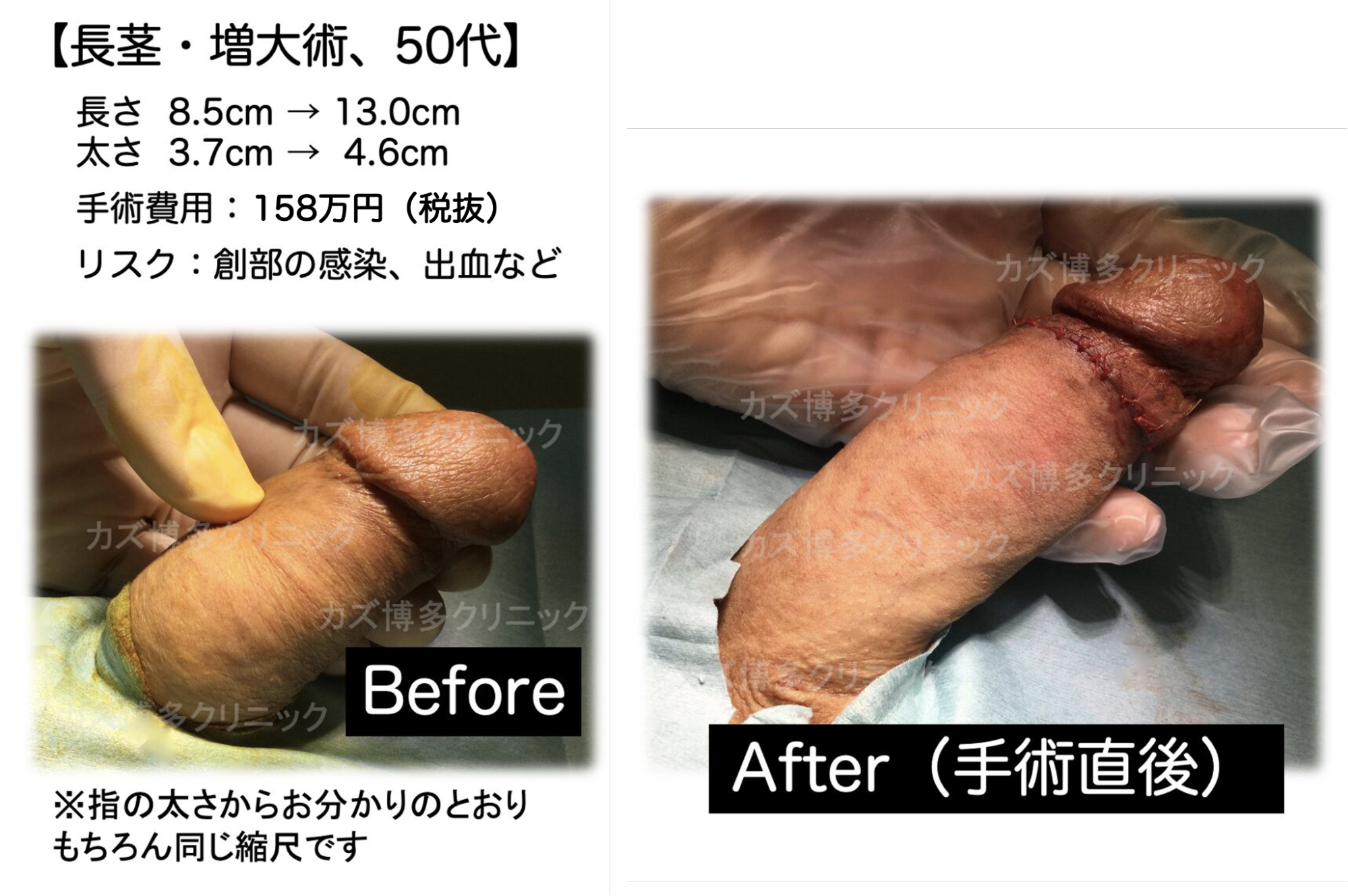 グランセンサー解除法によってサイズアップ（4.5cm）した症例