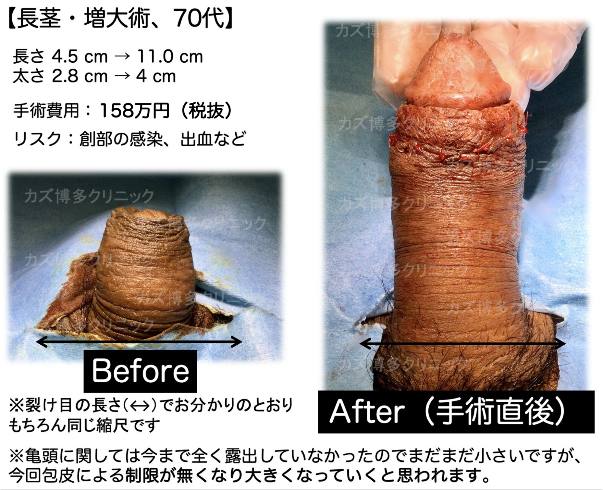 長茎手術によってサイズアップ（6.5cm）の症例