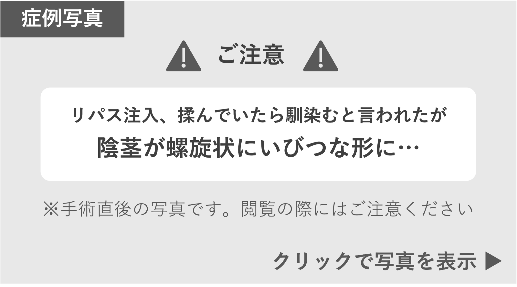リパス注入によって陰茎が螺旋状になった症例写真  症例写真閲覧の警告