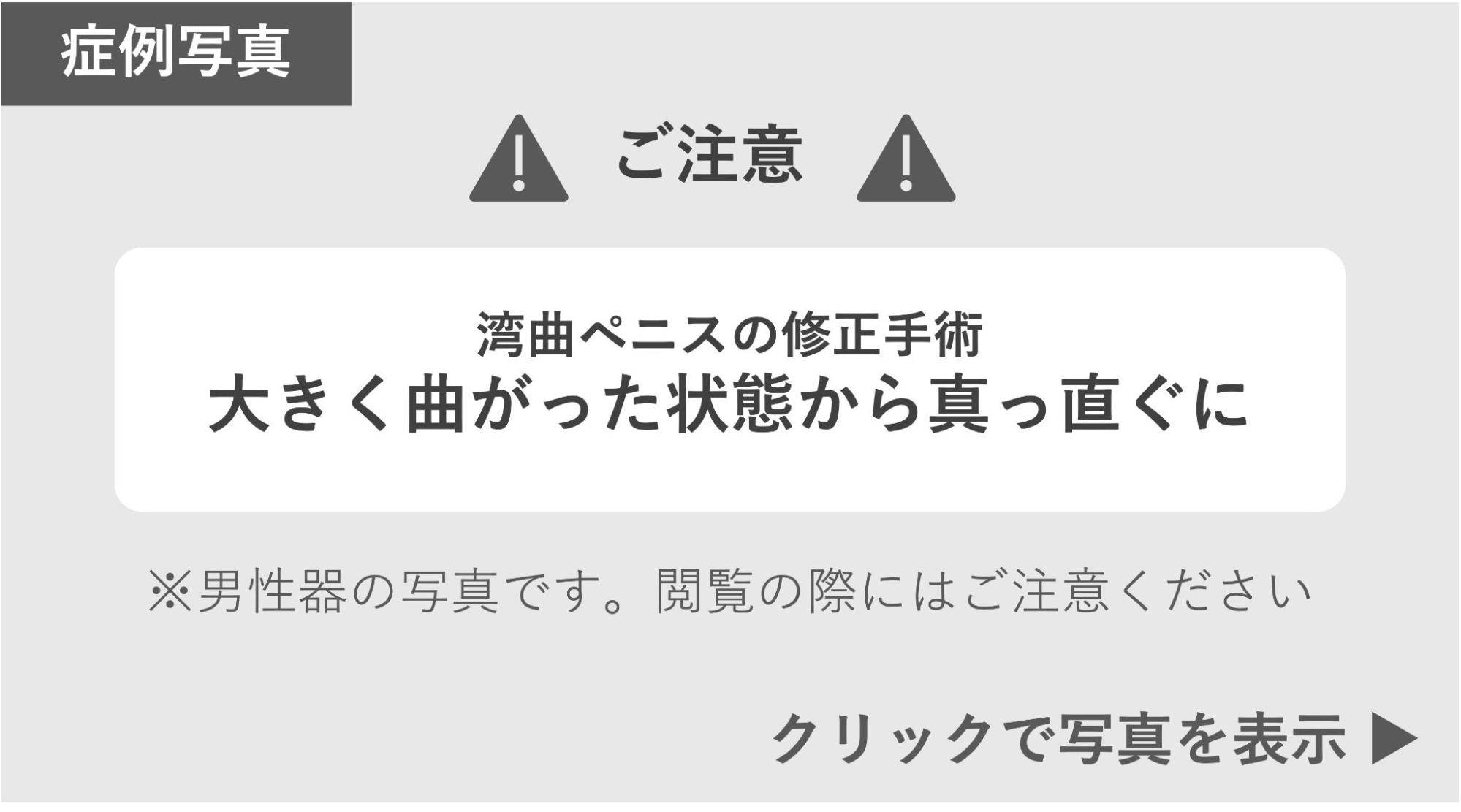 湾曲ペニスの修正手術の症例写真 症例写真閲覧の警告