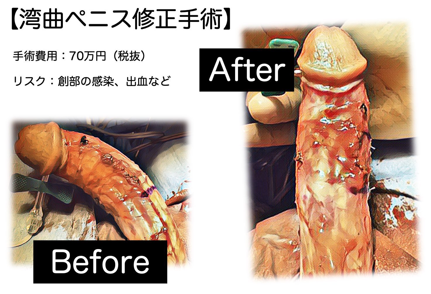 湾曲ペニスの修正手術の症例写真