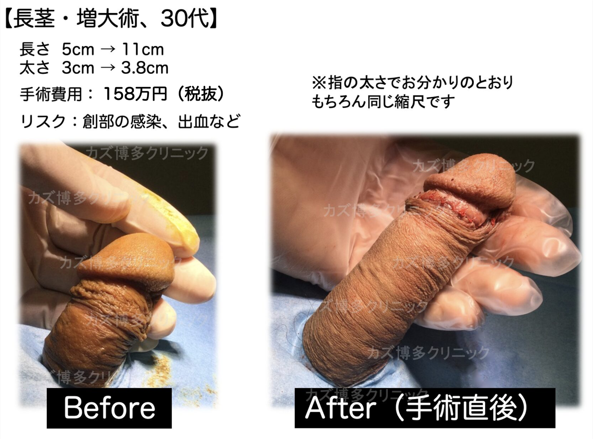 長茎手術によってサイズアップ（6cm）の症例