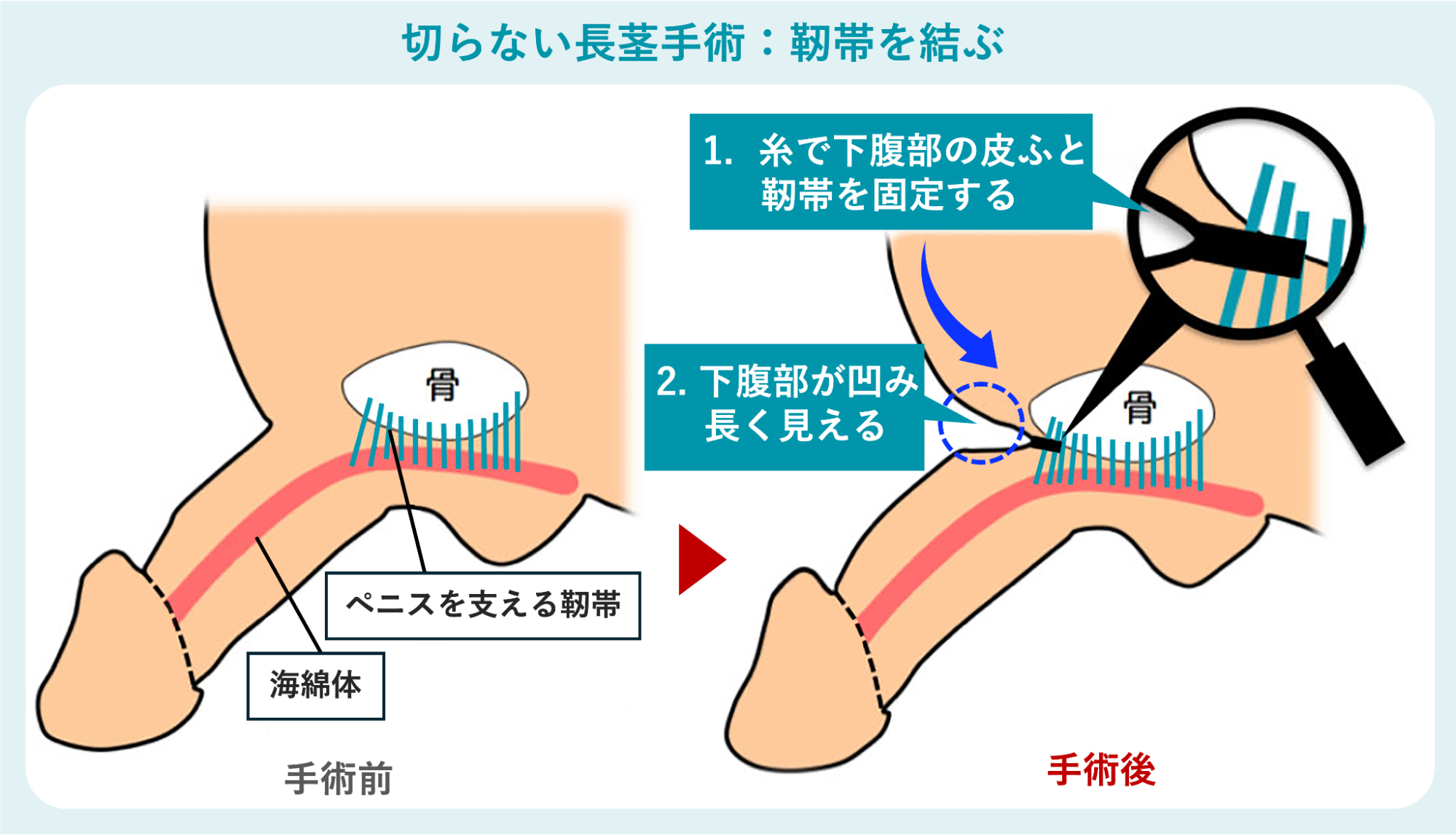 【危険】切らない長茎手術（靭帯を結ぶ）の費用相場は「約8〜33万円以上」