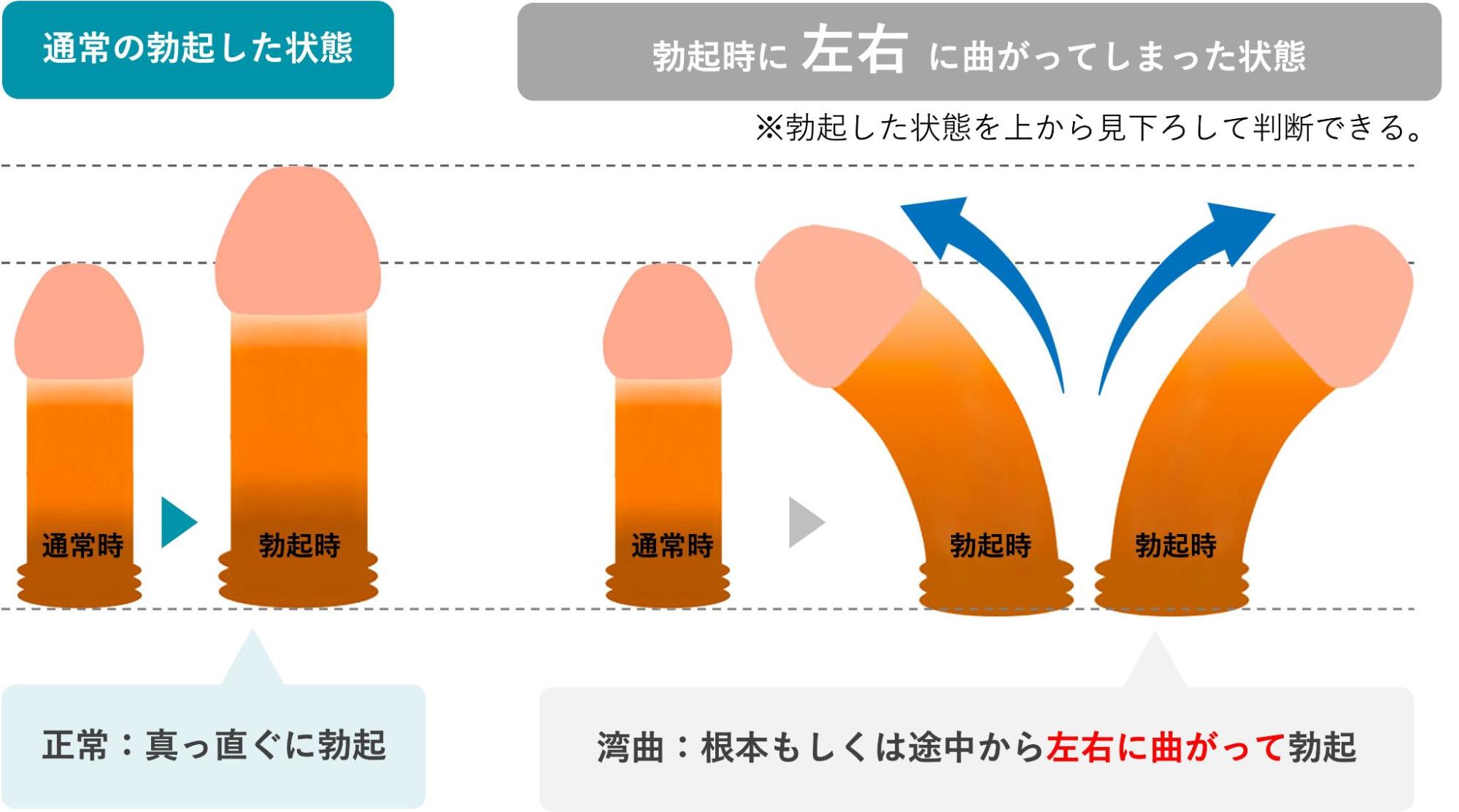 左右に湾曲している場合のイメージ