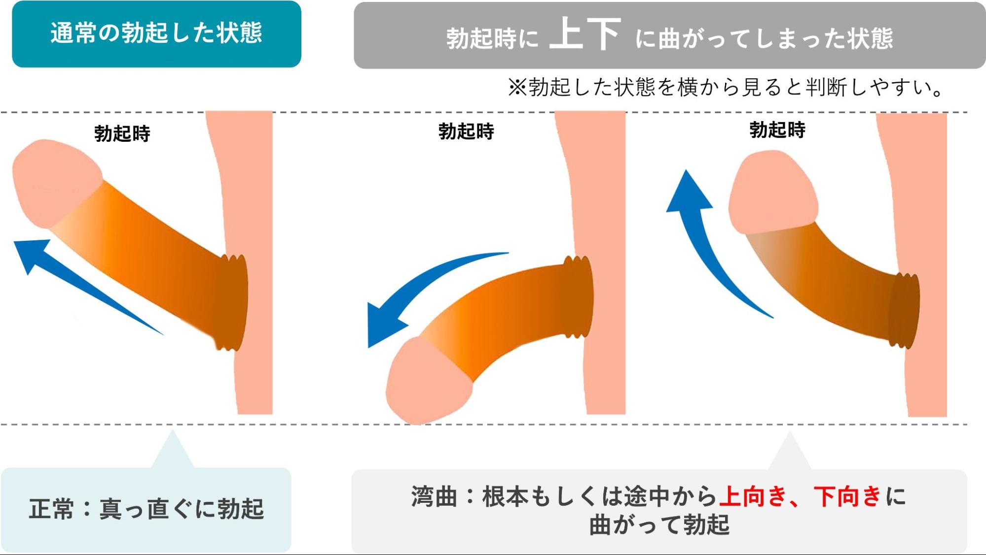 上下に湾曲している場合のイメージ