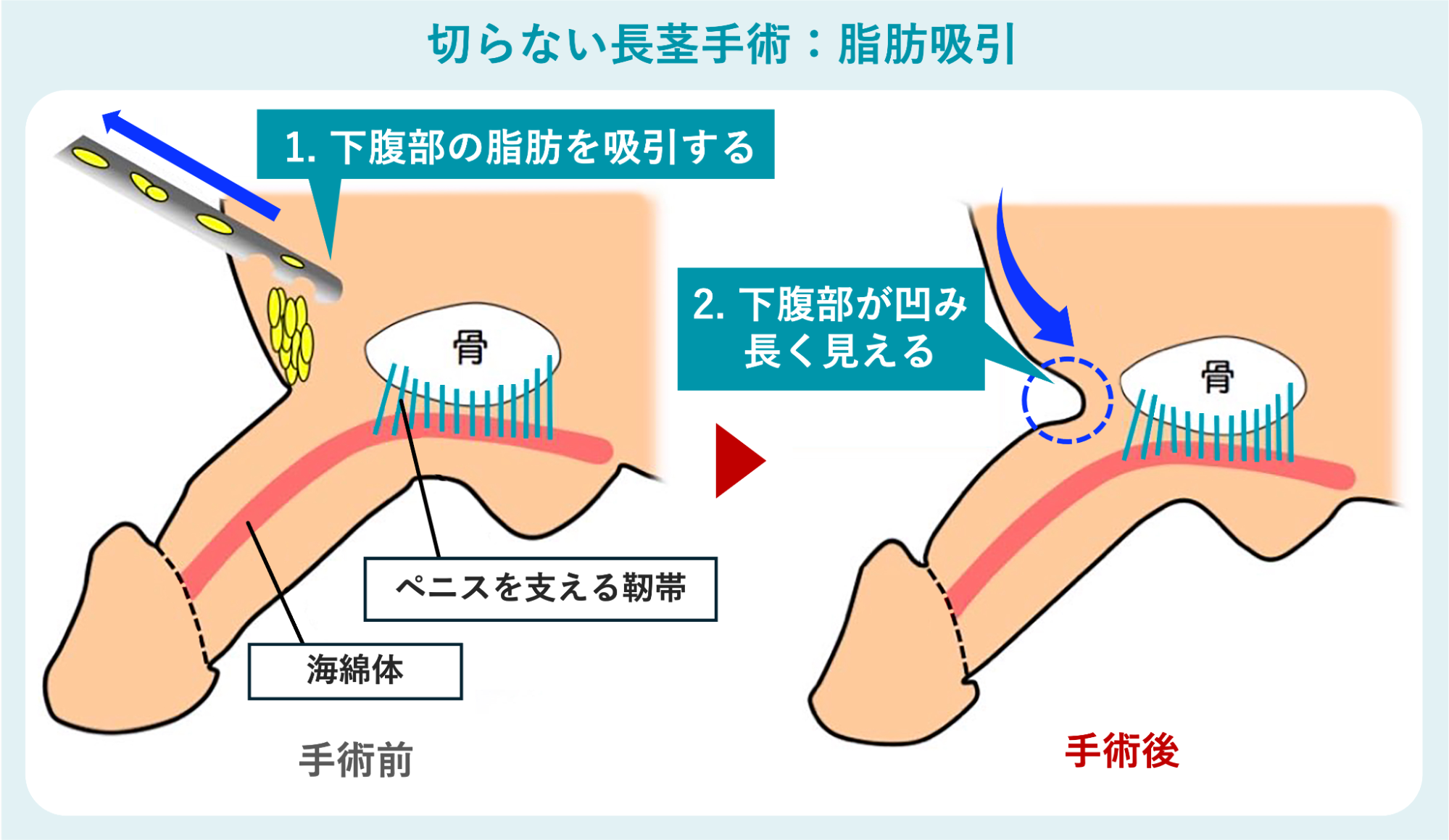 切らない長茎手術での脂肪吸引のイメージ