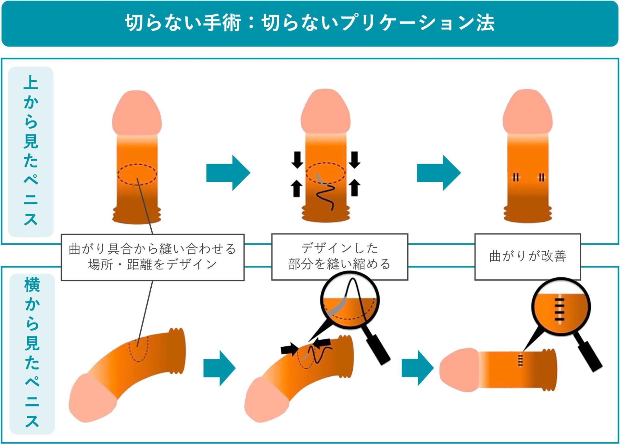 切らないプリケーション法の概要