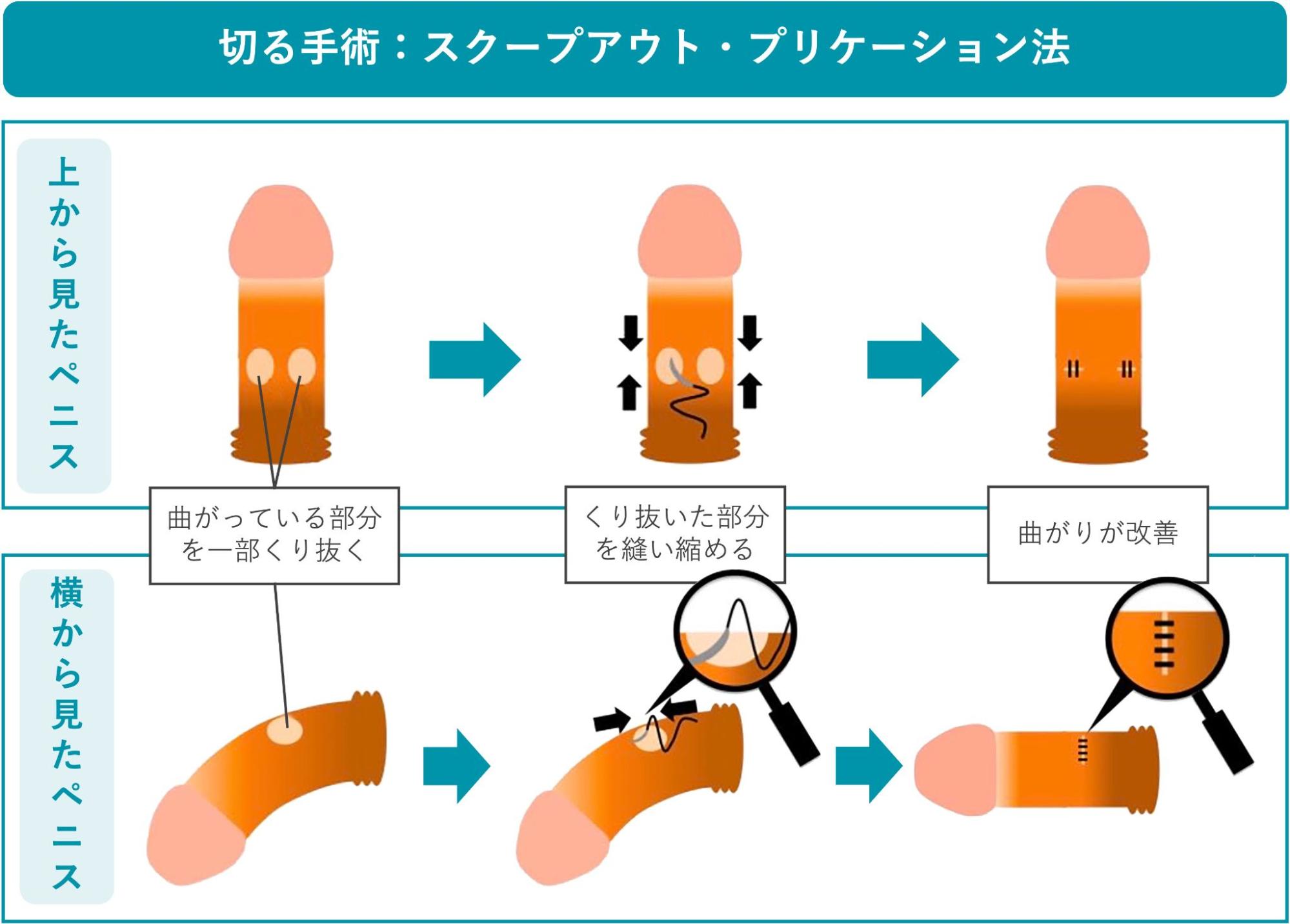 スクープアウト・プリケーション法の概要