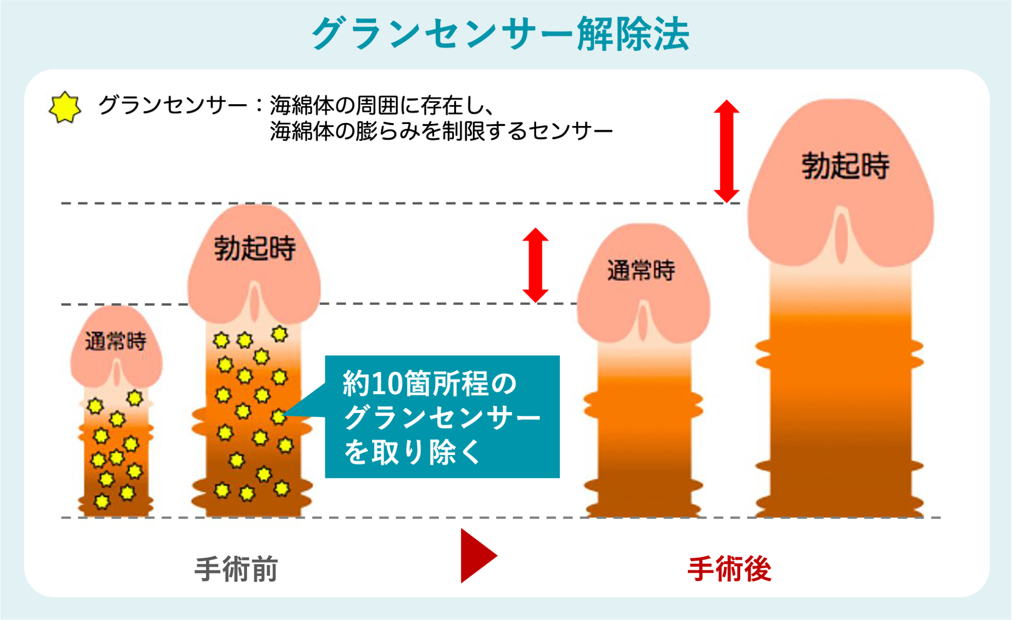 【安心・効果大】グランセンサー解除法による長茎手術の費用相場「158万円」