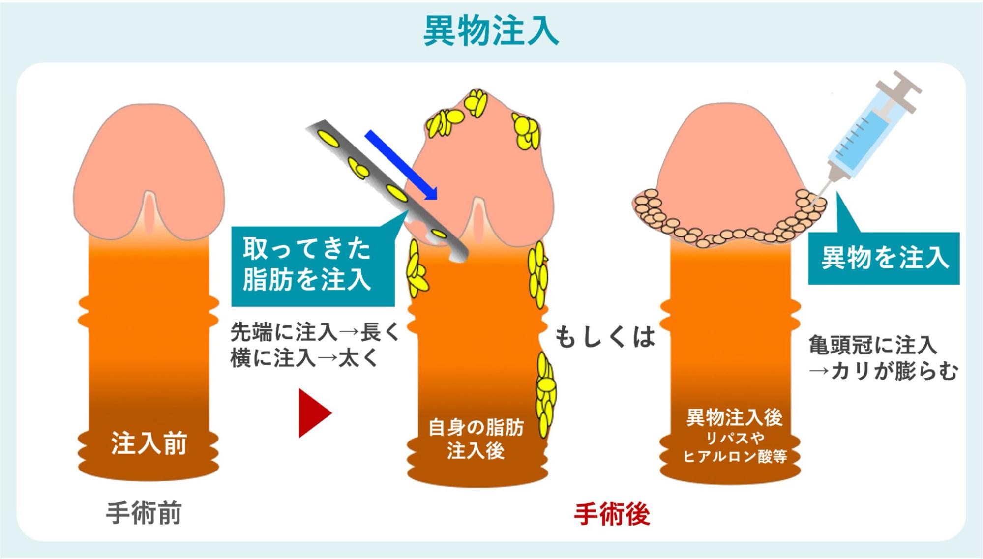 異物注入で亀頭・陰茎を大きくするペニス増大手術の費用は「約4〜3,300万円以上」