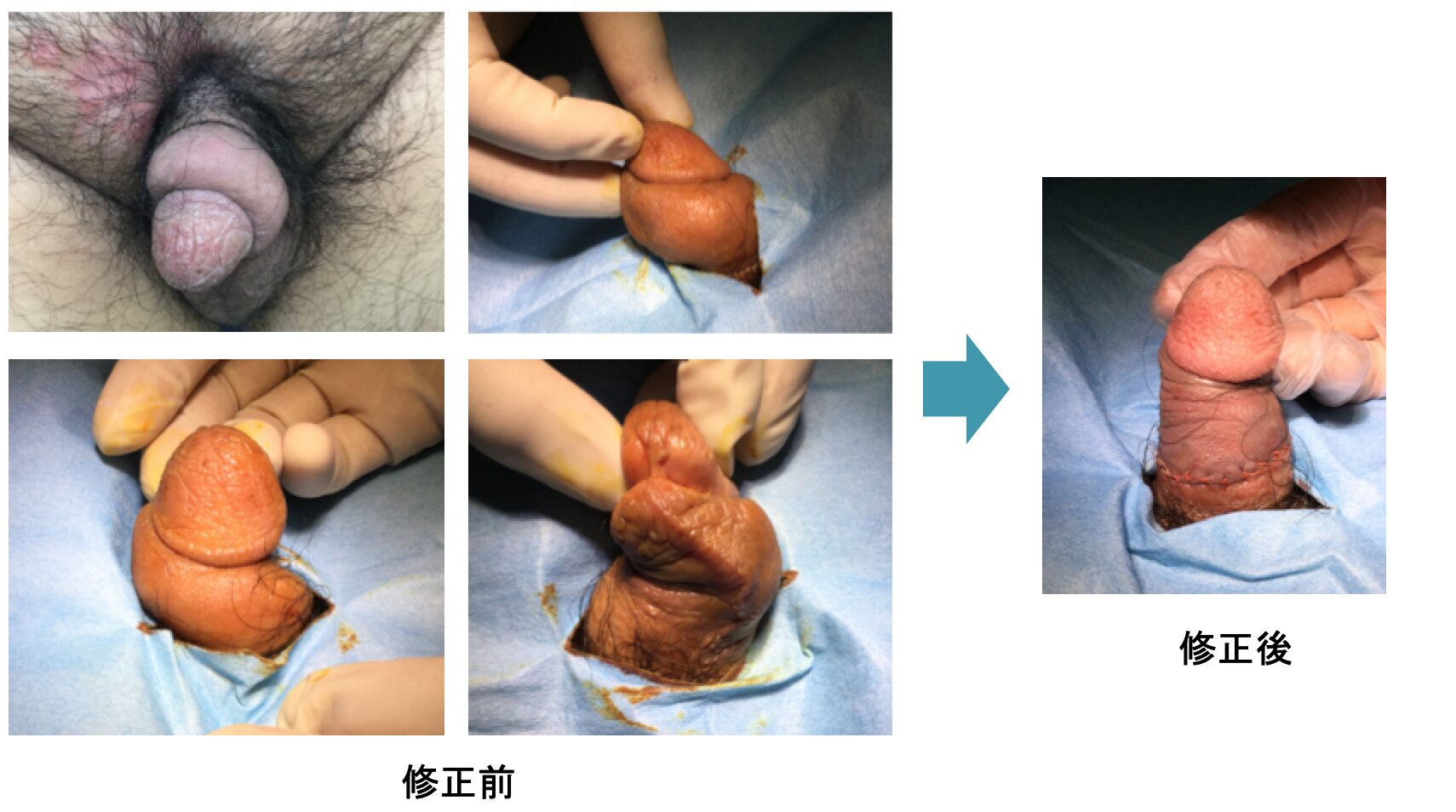 リパス注入によって陰茎が螺旋状になった症例写真