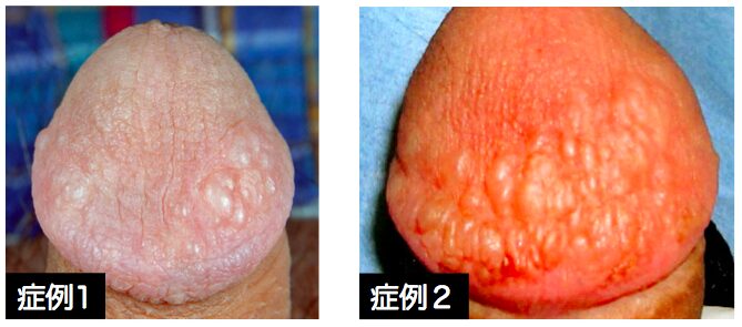 脂肪注入によって表面が水膨れのようになったペニスの症例写真