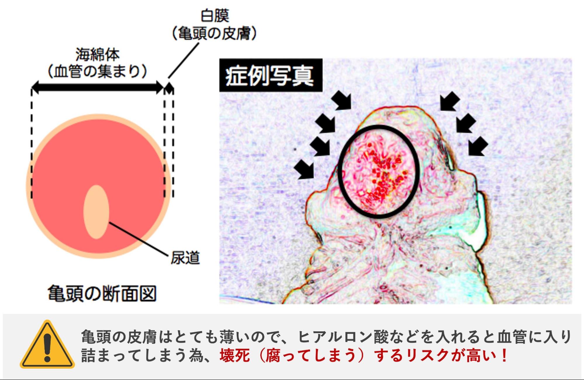 注入剤の影響でペニスが壊死した症例写真