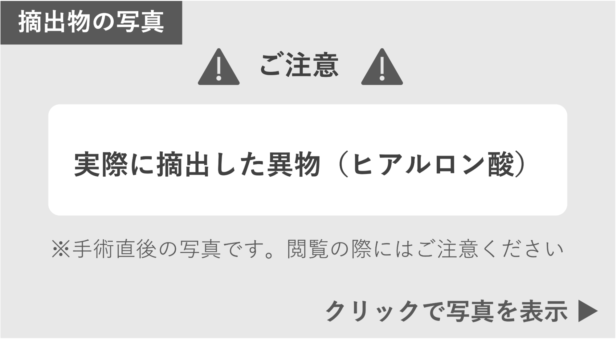 実際に摘出した異物（ヒアルロン酸）の写真  症例写真閲覧の警告