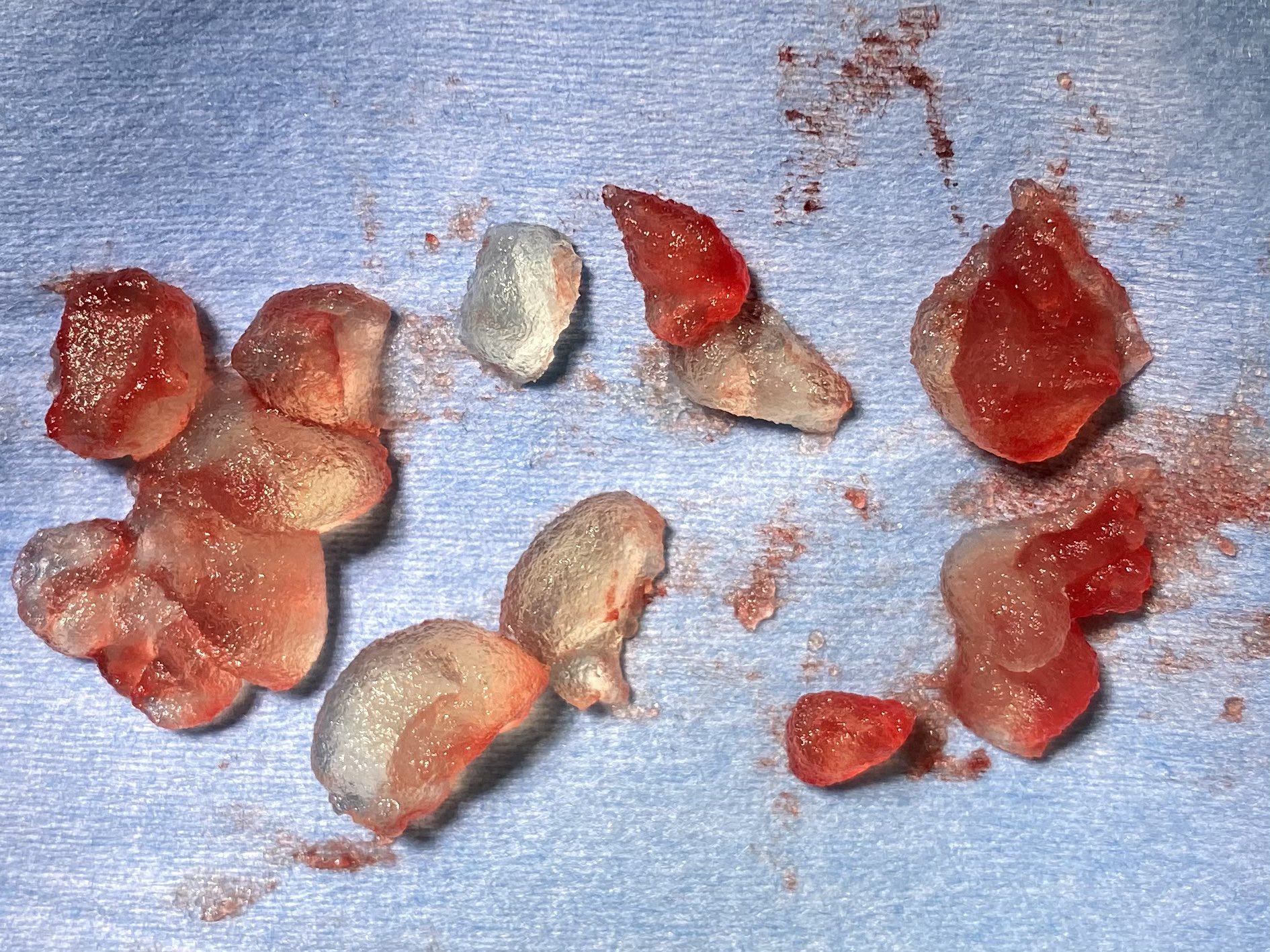 実際に摘出した異物（ヒアルロン酸）の写真