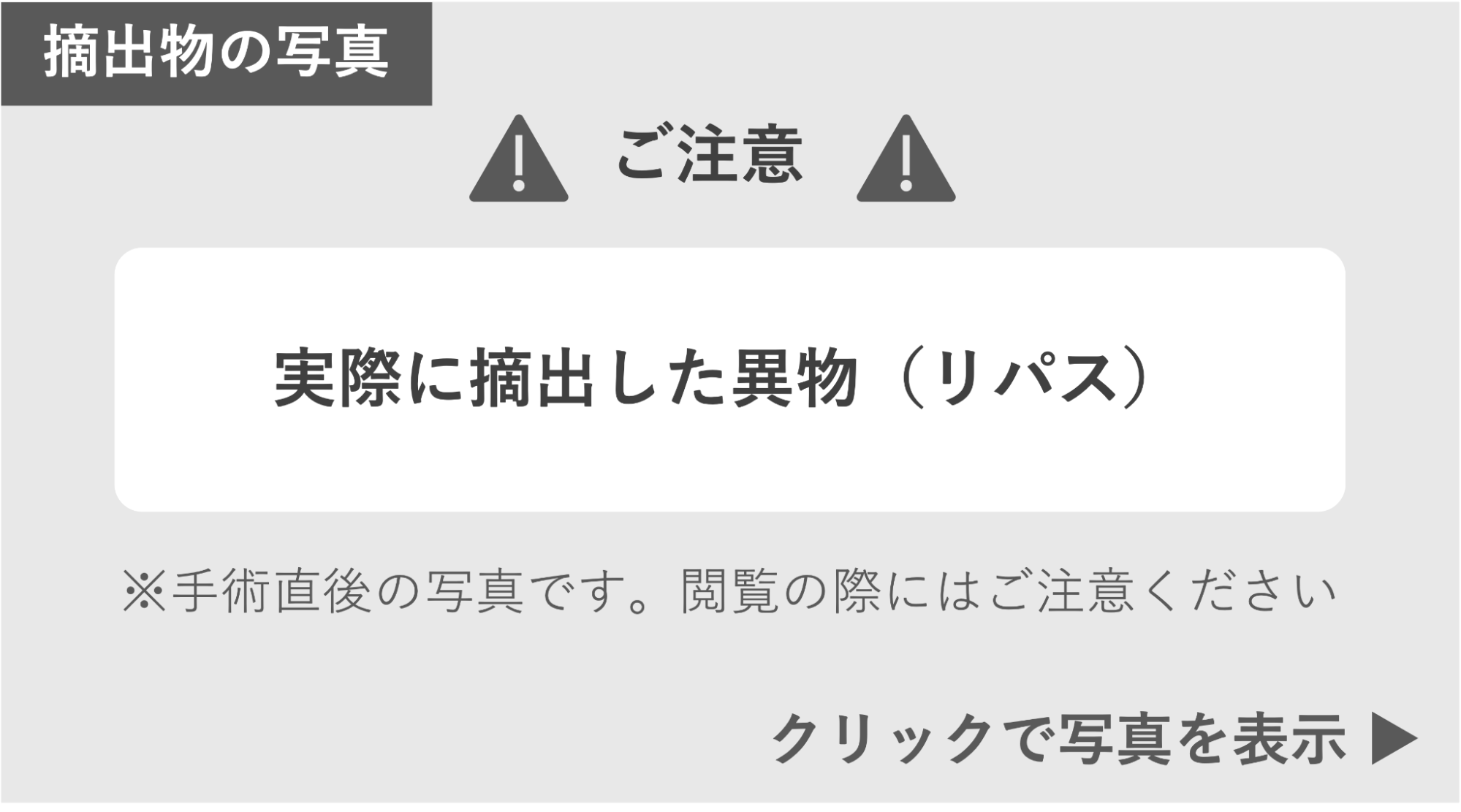 実際に摘出した異物（リパス）の写真  症例写真閲覧の警告