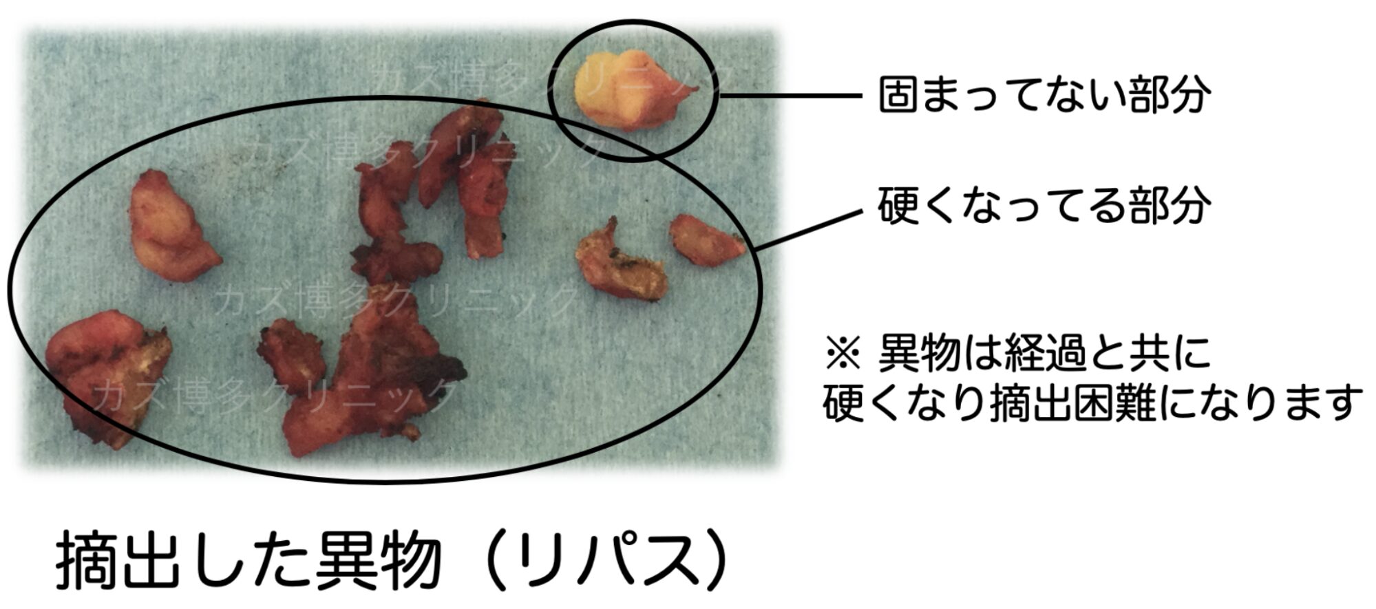 実際に摘出した異物（リパス）の写真