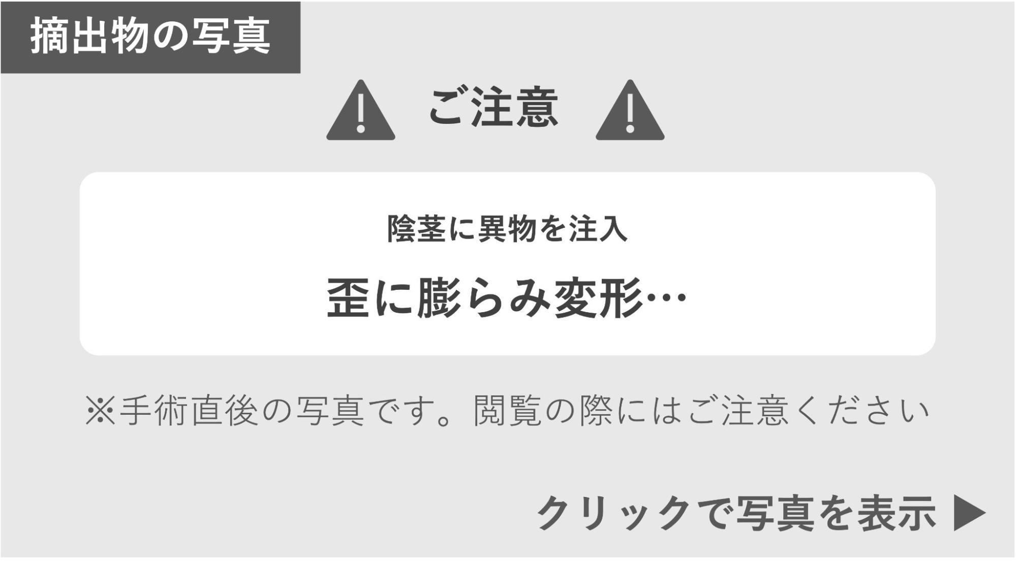 陰茎に異物を注入し歪に膨らみ変形したペニスの症例写真 症例写真閲覧の警告