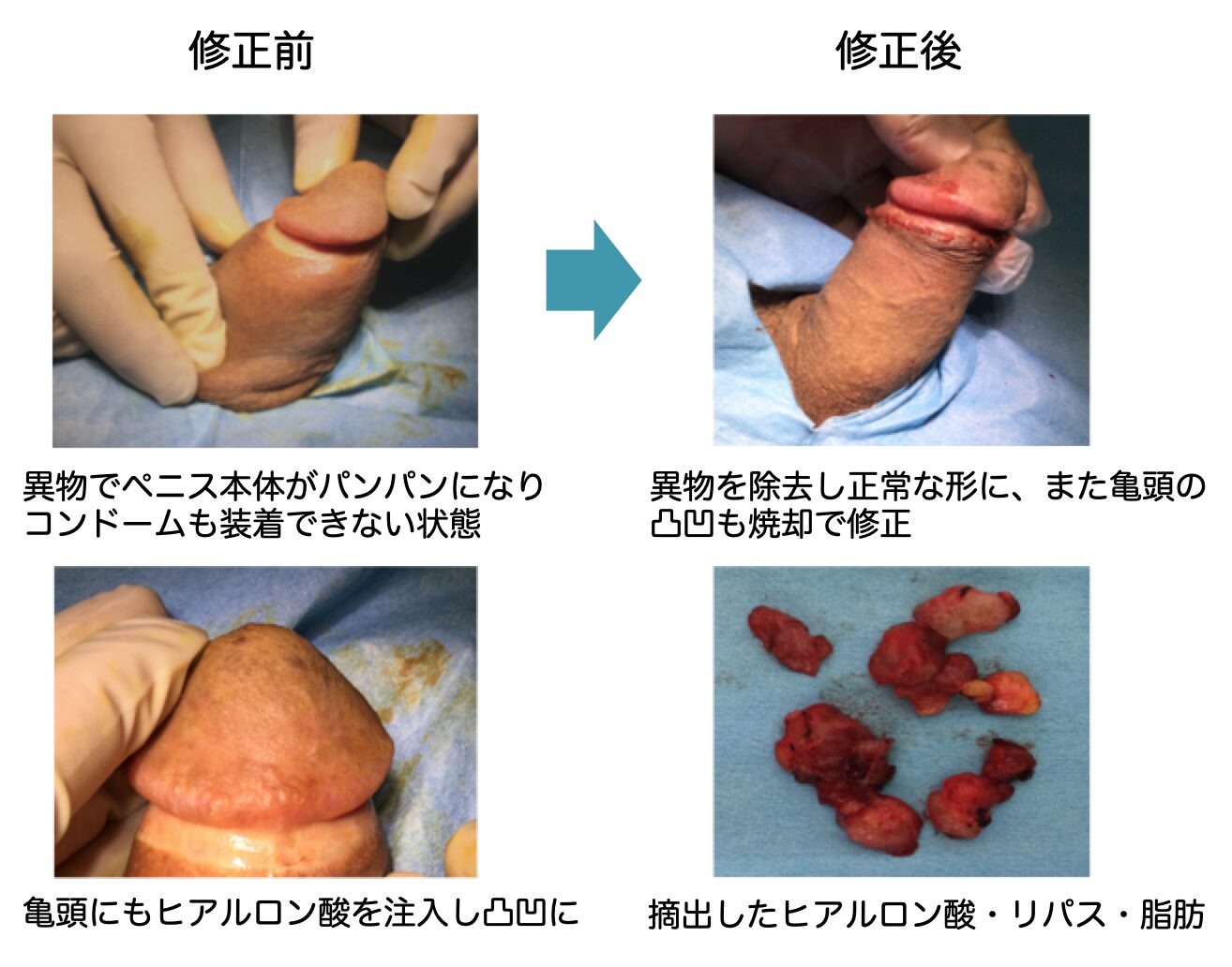 注入を続け変形してしまったペニスの症例写真