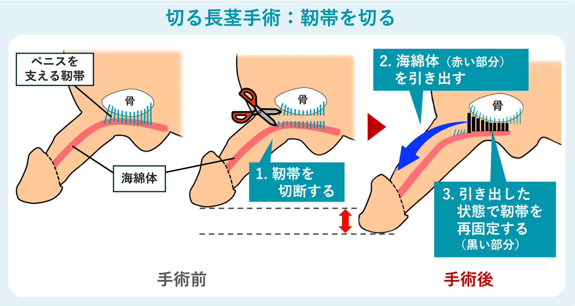 靭帯を切る長茎手術のイメージ