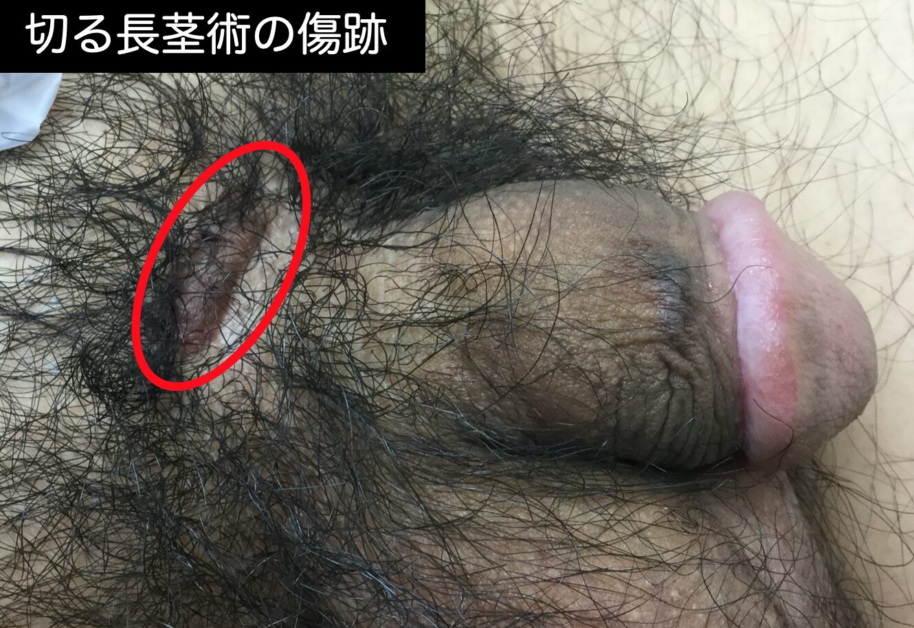 切る長茎手術によって根元に大きな傷跡