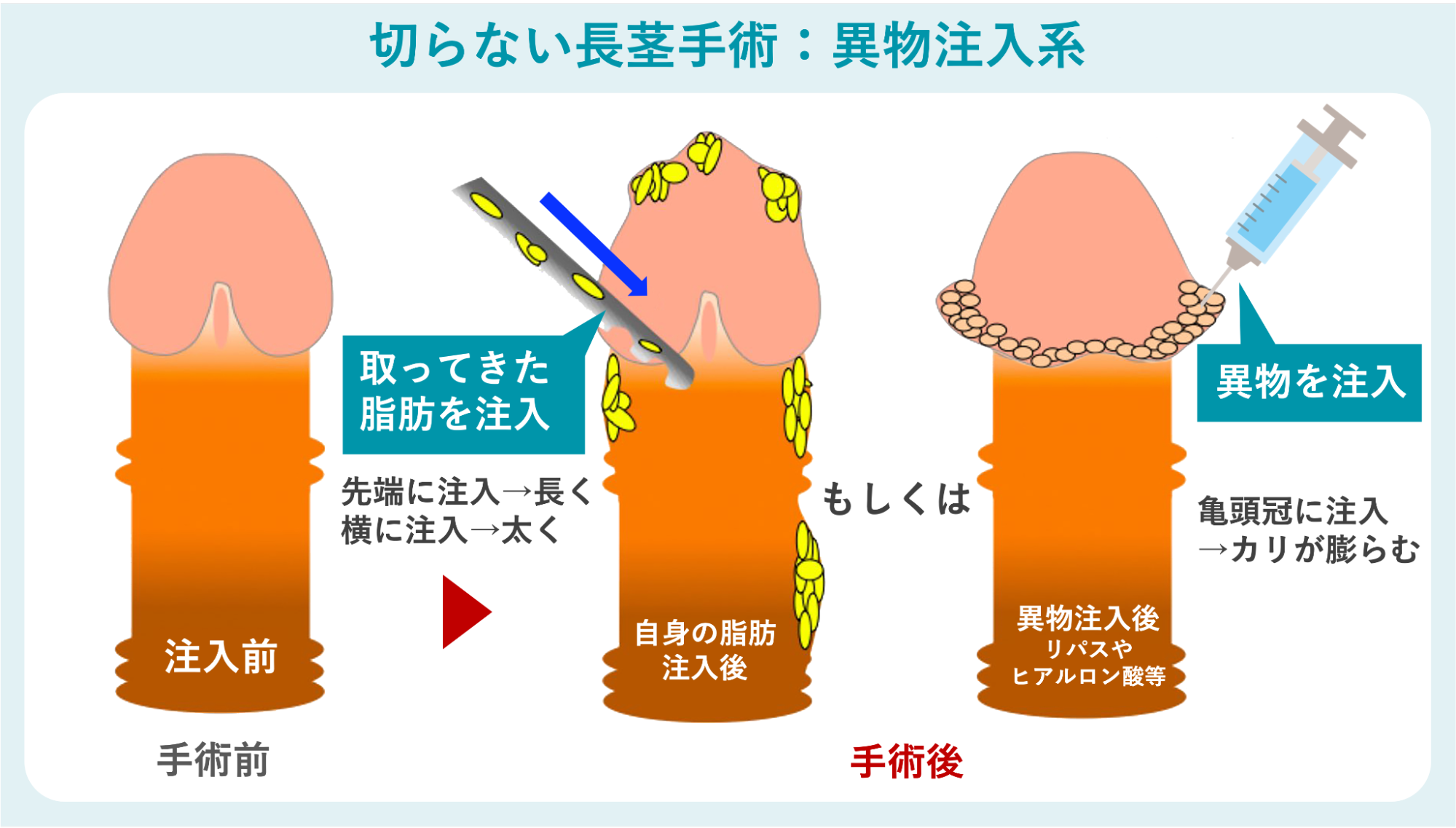 異物注入系の長茎手術のイメージ