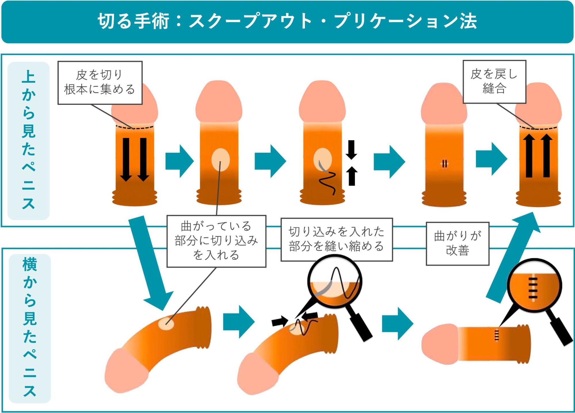 スクープアウト・プリケーション法の概要