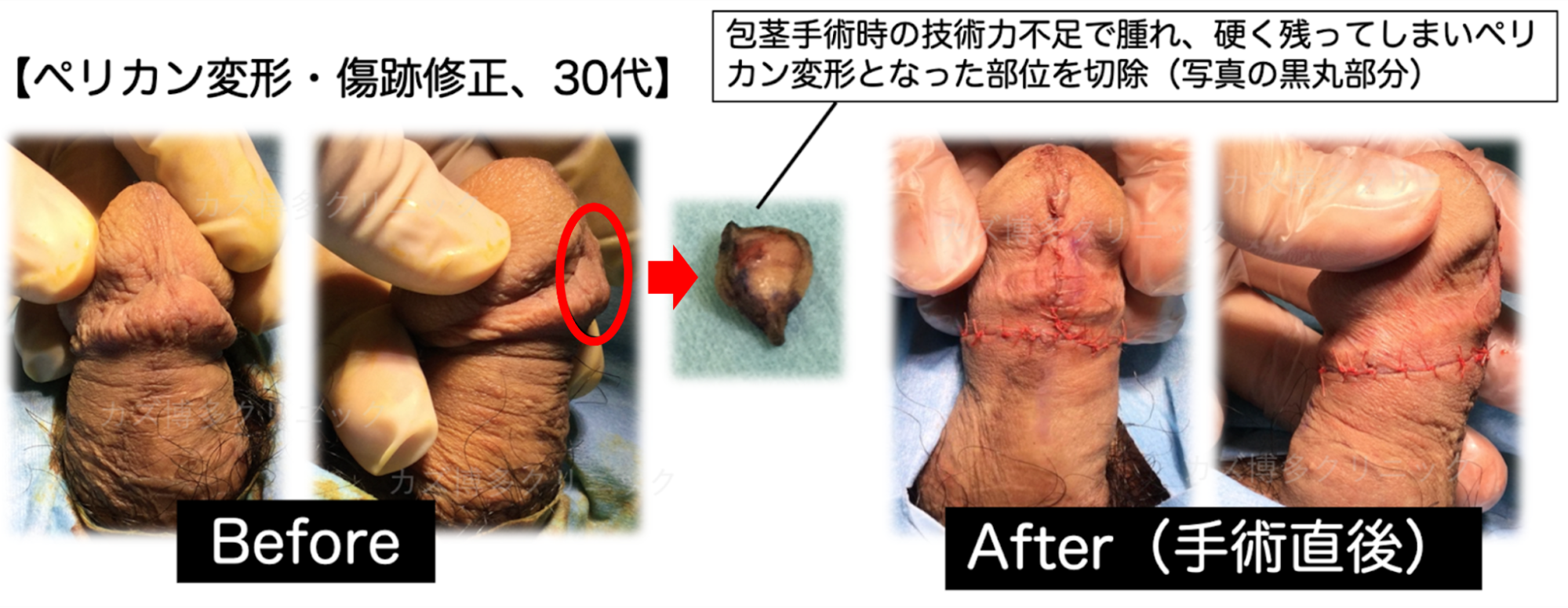 医師の記述不足でペリカン変形になった症例