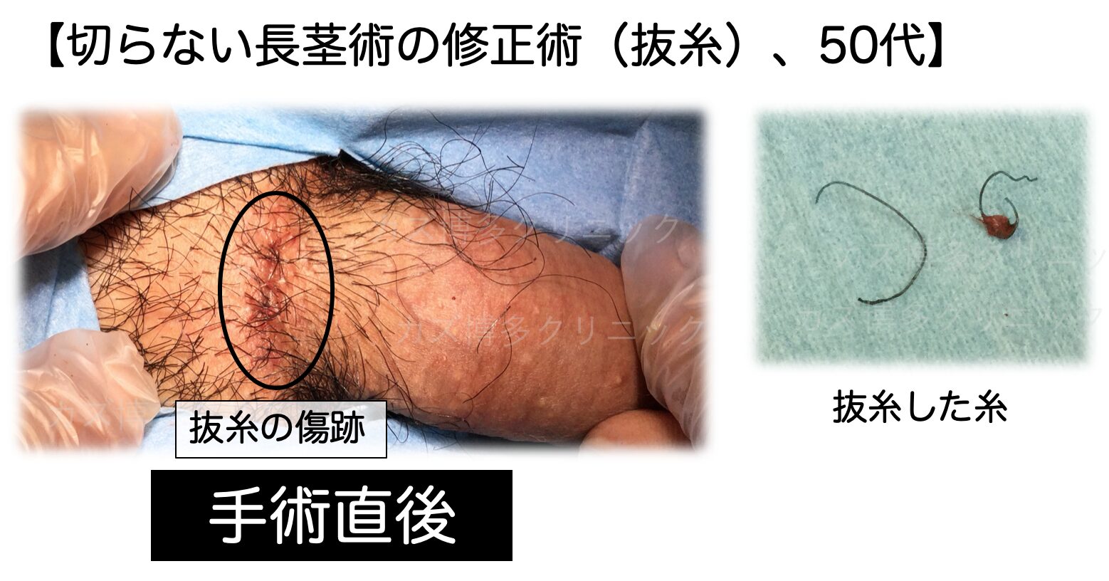 ペニスの根元に大きな縫い目が残った症例