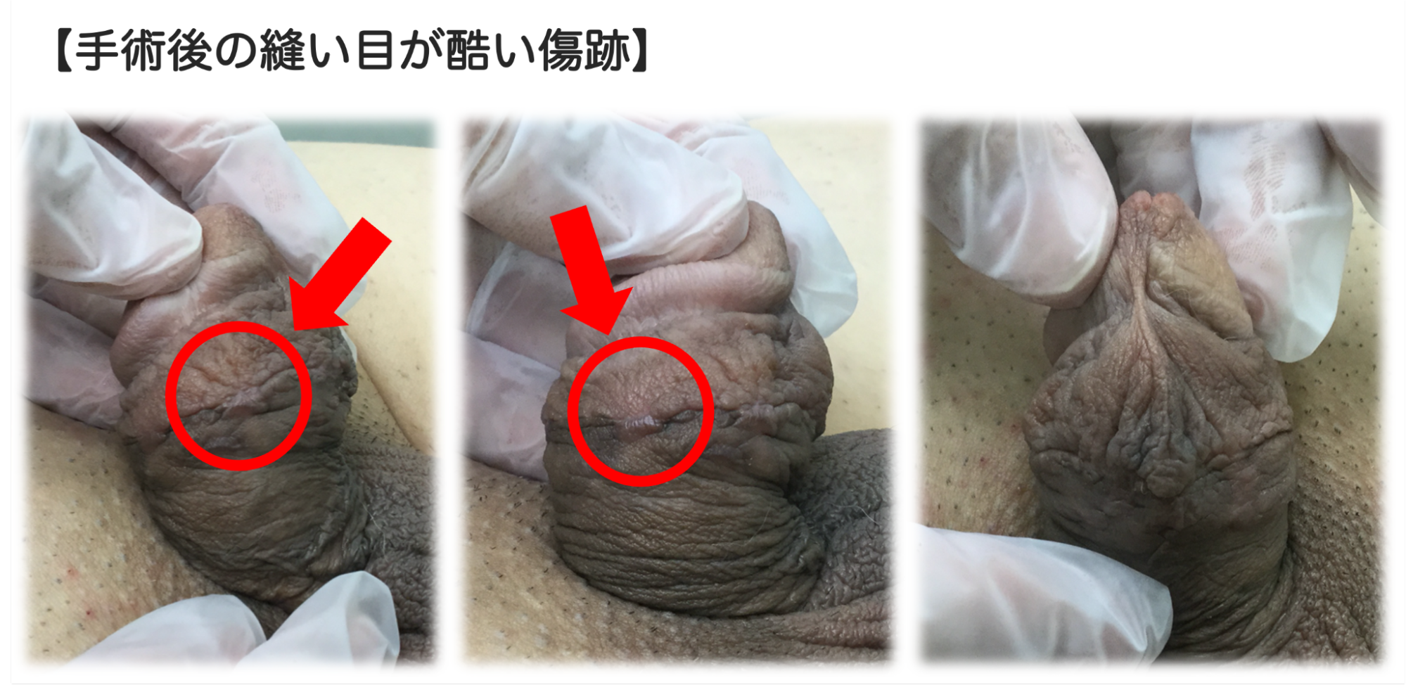 あからさまに縫い目が残った傷跡の症例