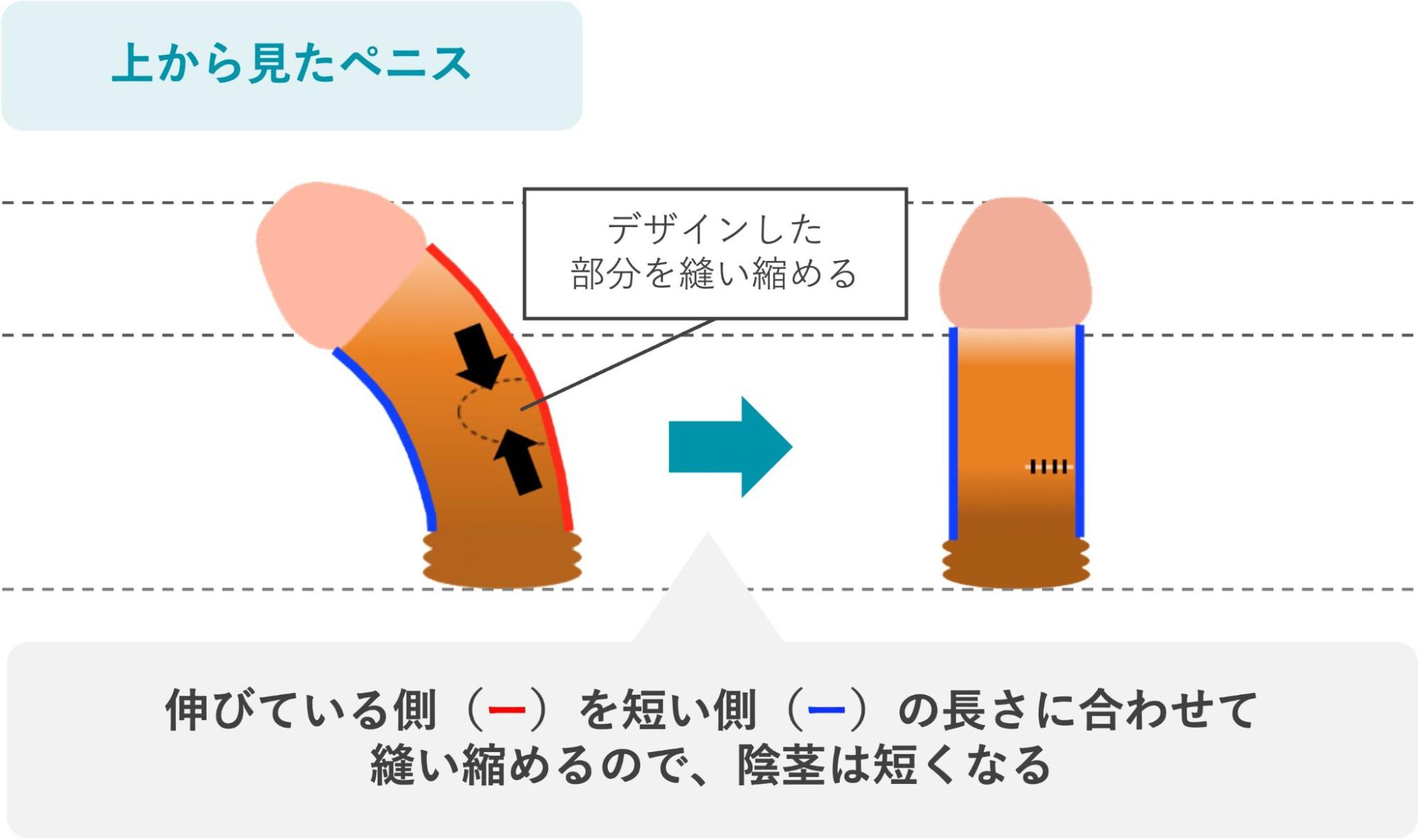 手術で真っ直ぐになったが短くなったペニスを上から見たイメージ