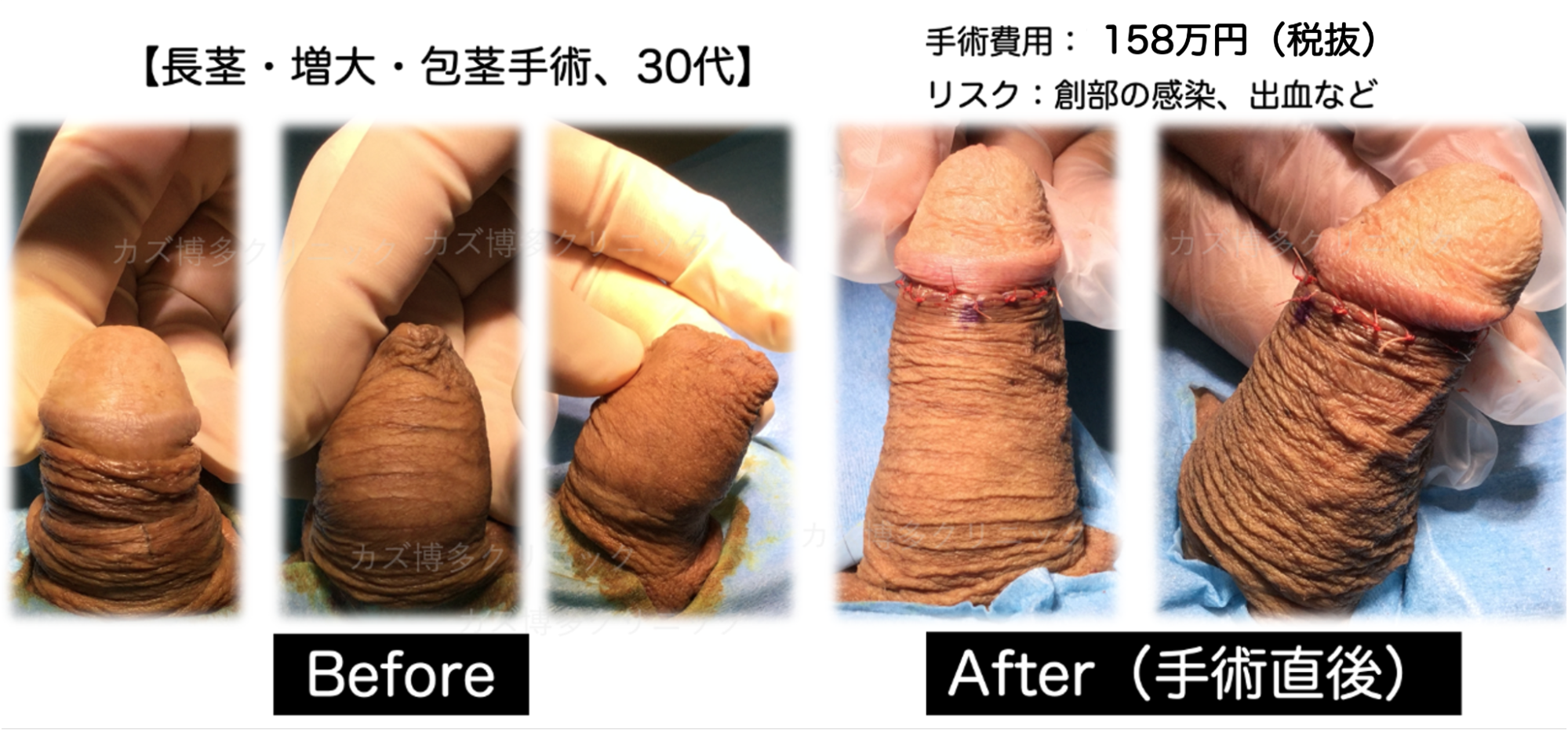 仮性包茎ペニスが長さ太さもサイズアップした症例