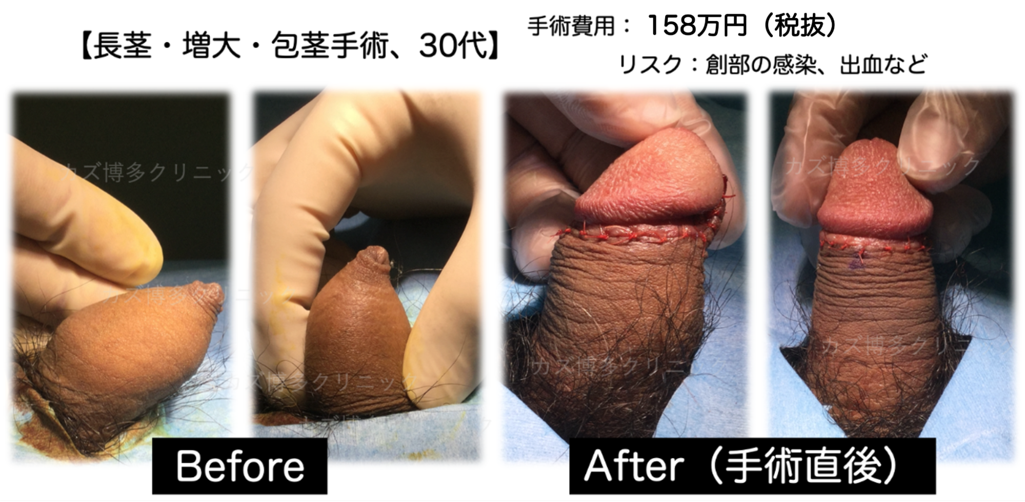 真正包茎のマイクロペニスから大幅サイズアップした症例