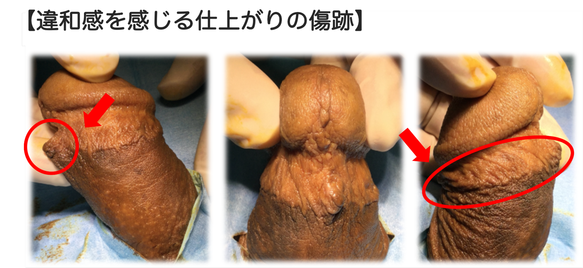 縫いあとがツートンカラー・凸凹になった症例