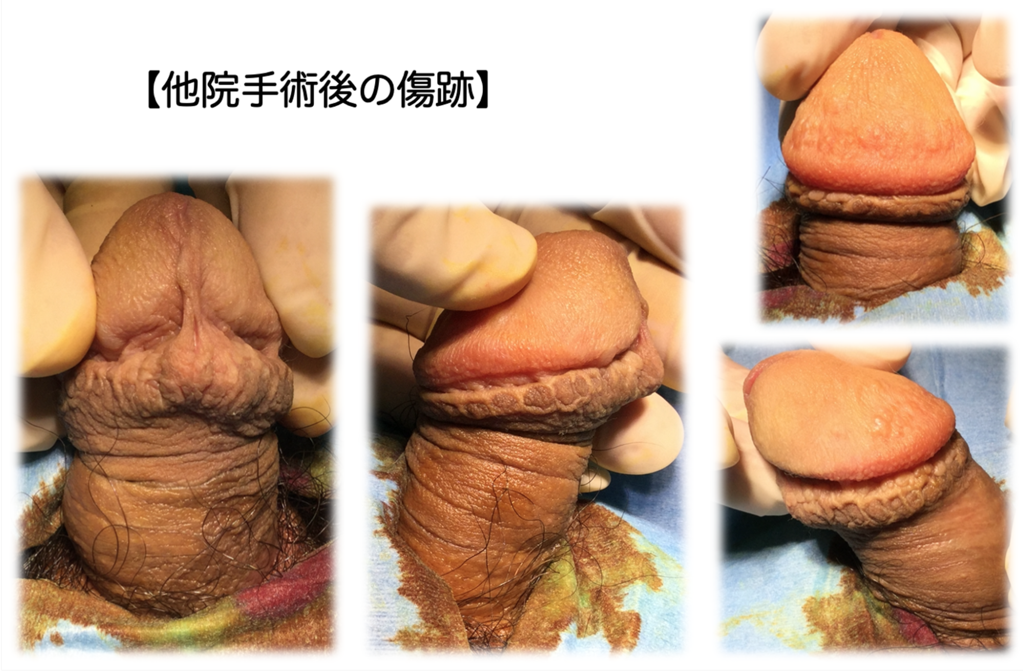 他院手術で凸凹になった傷跡の症例