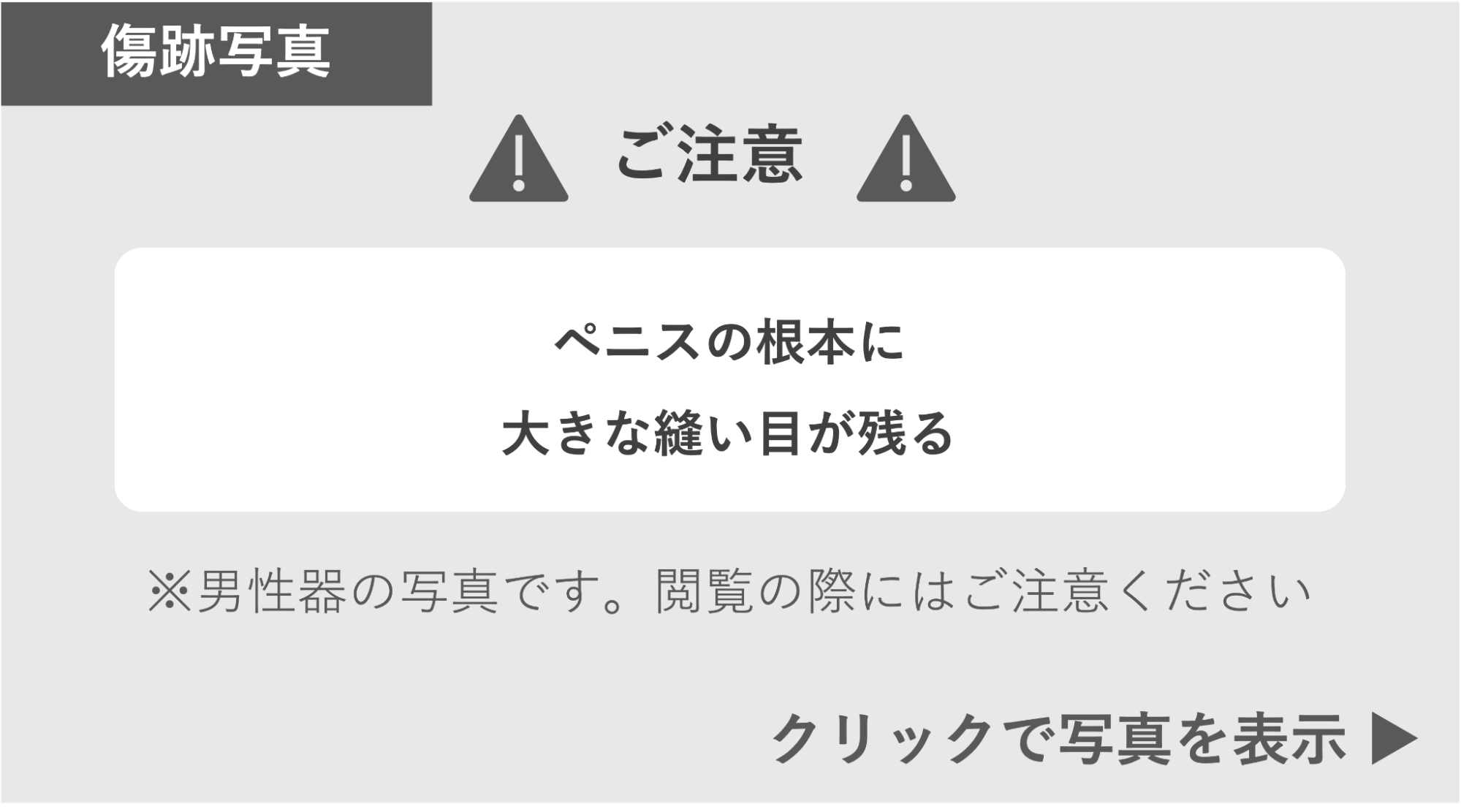 ペニスの根元に大きな縫い目が残った症例 症例写真閲覧の警告