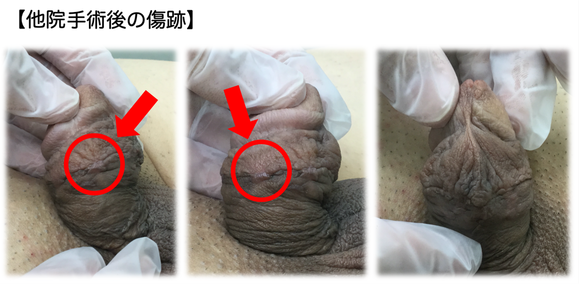 他院手術で縫い目が目立つ仕上がりの症例