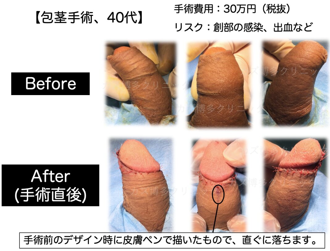 亀頭包皮炎を回避する包茎手術