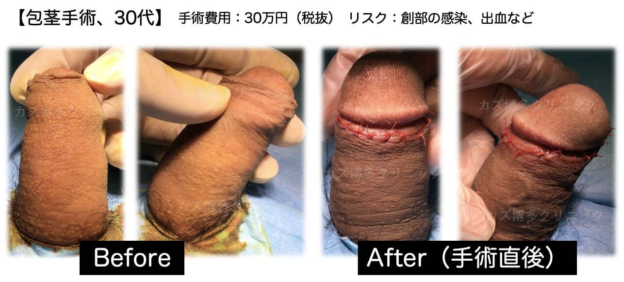 術後の痛み・傷跡が気にならない包茎手術