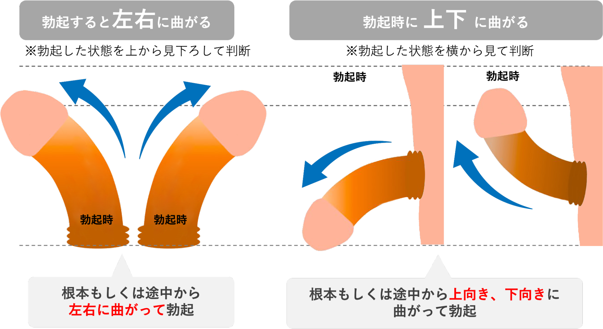 勃起時にペニスが上下左右に曲がっているかの判断方法