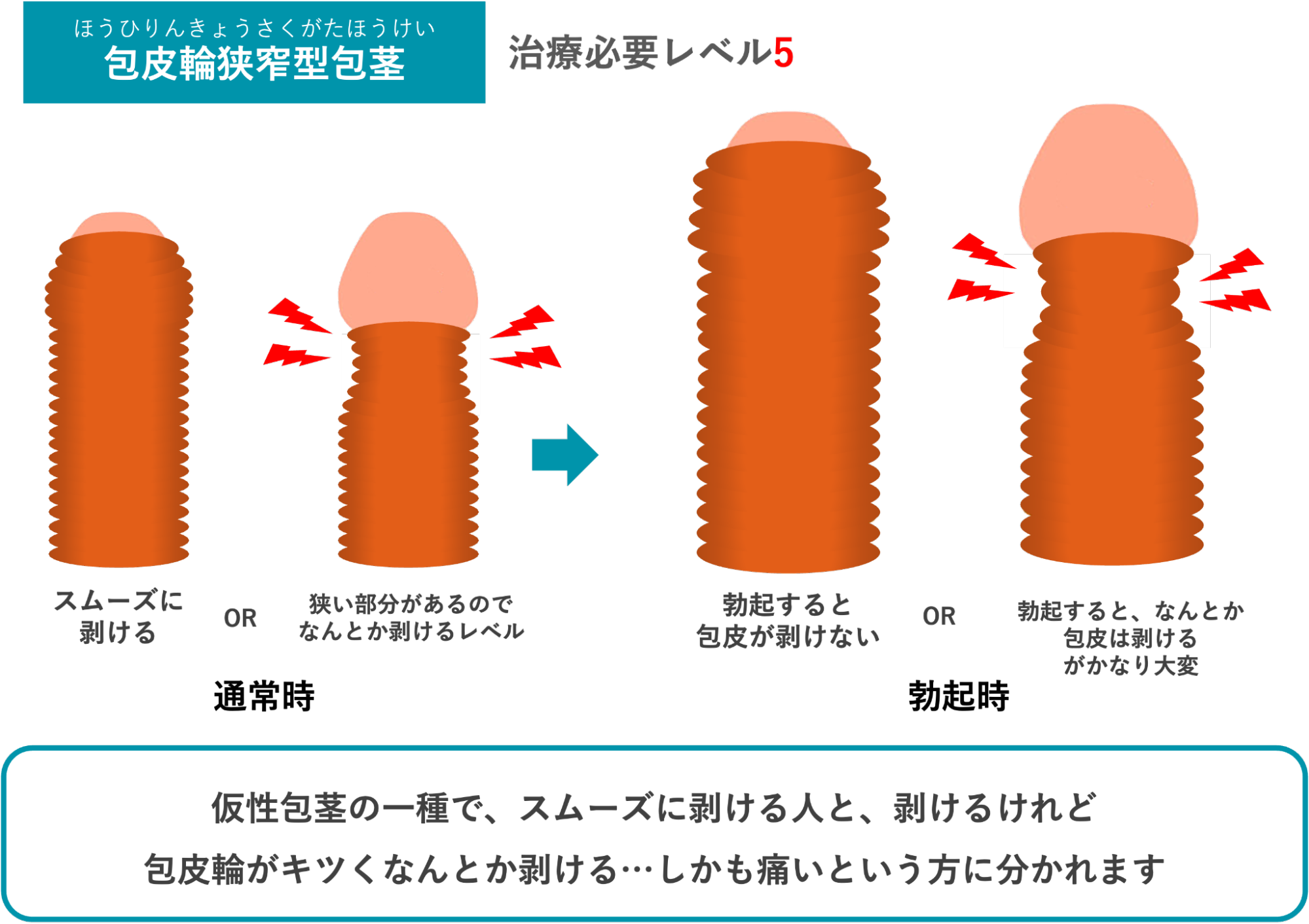 包皮輪狭窄型包茎のイメージ