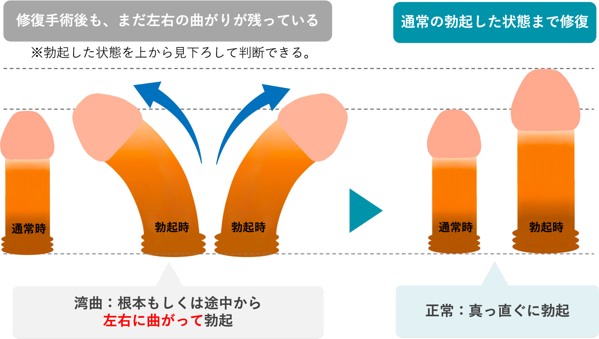 手術後も曲がったままのペニスと真っ直ぐに修正されたペニスのイメージ