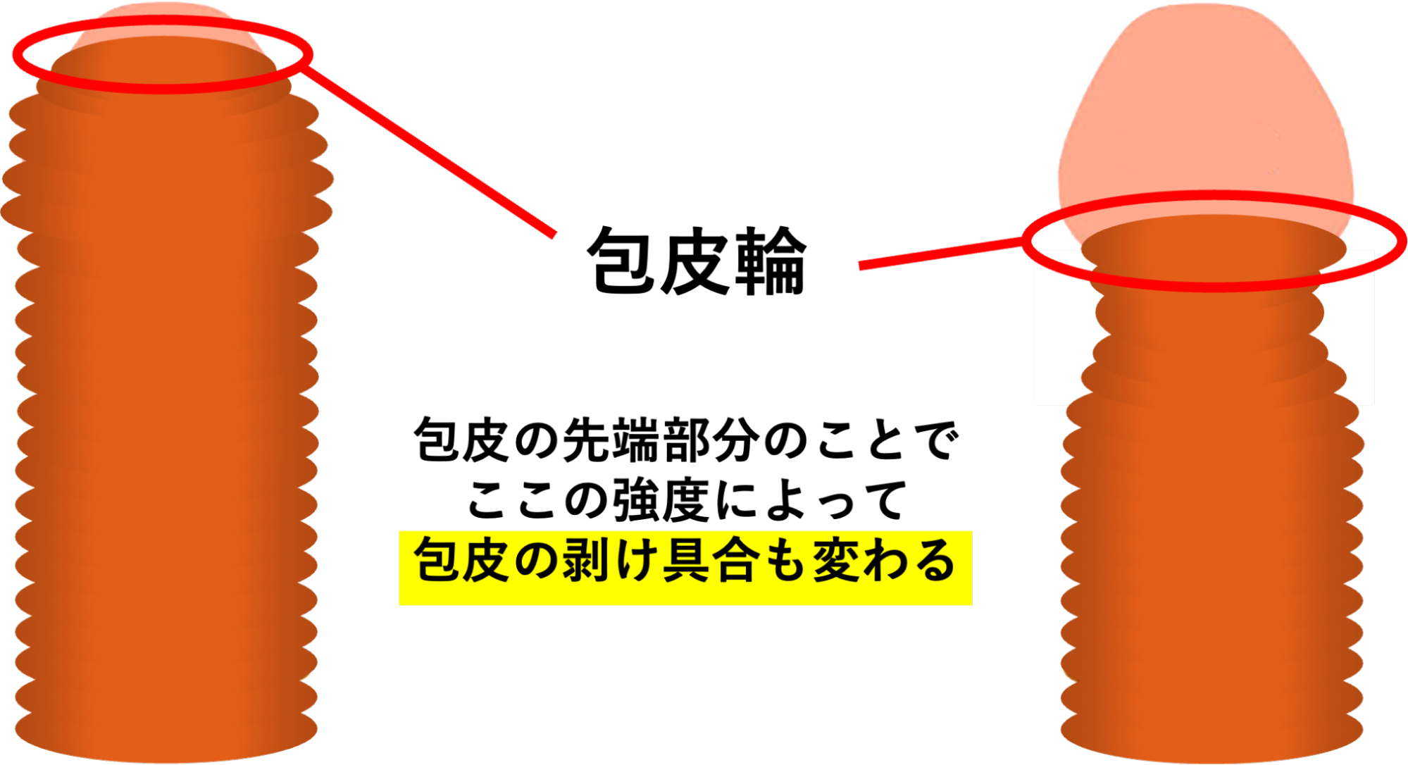 包皮輪の部分が狭い包茎ちんこイメージ