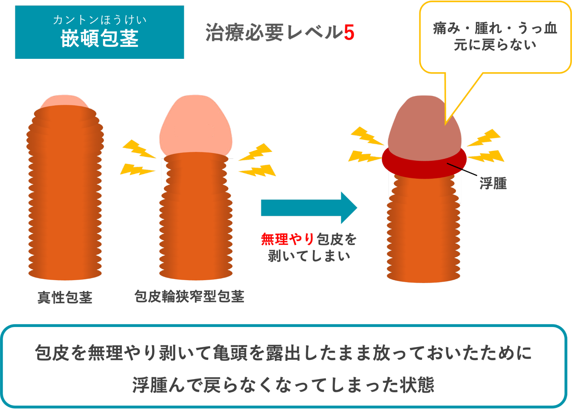 嵌頓包茎のイメージ