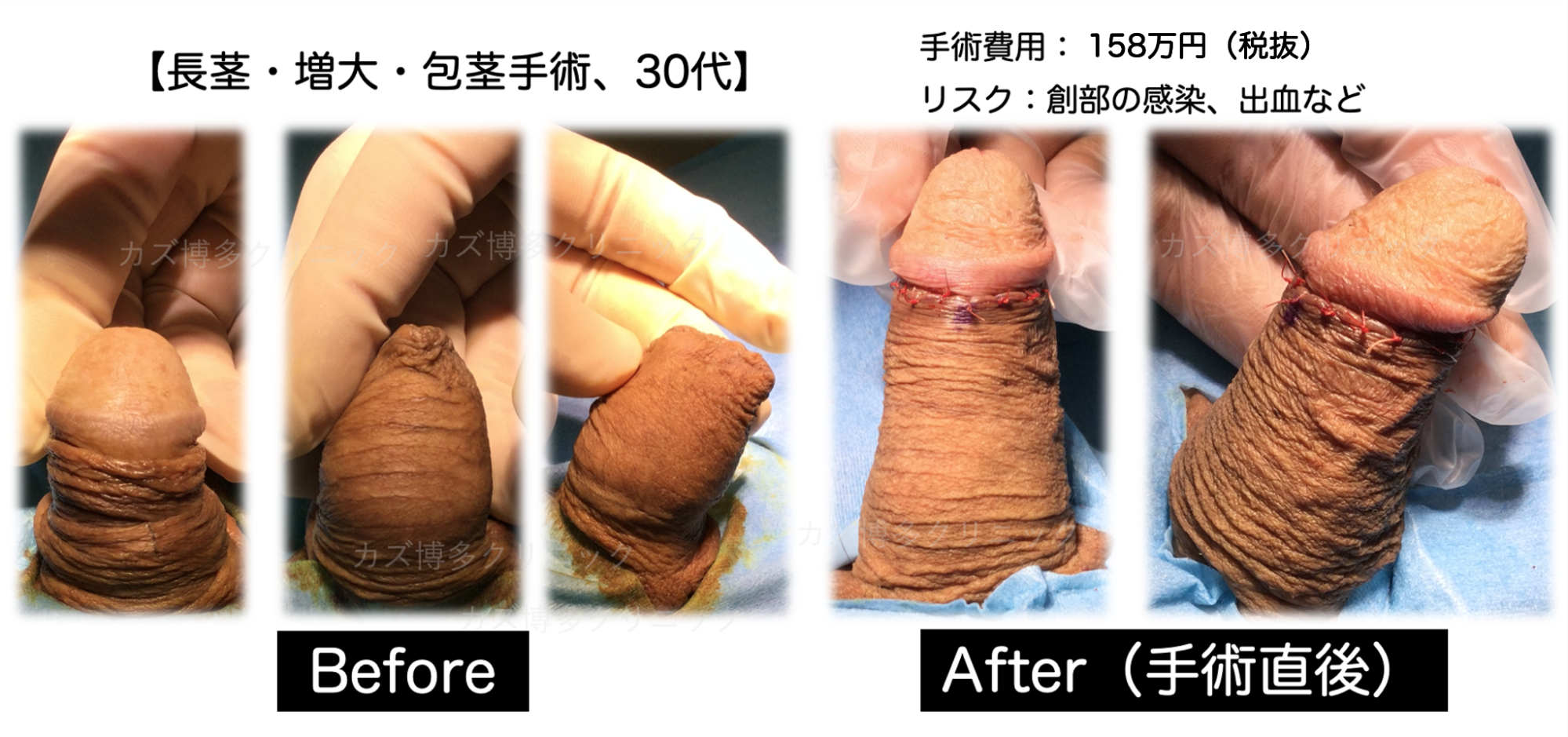 長さ太さに加え、包茎改善の症例