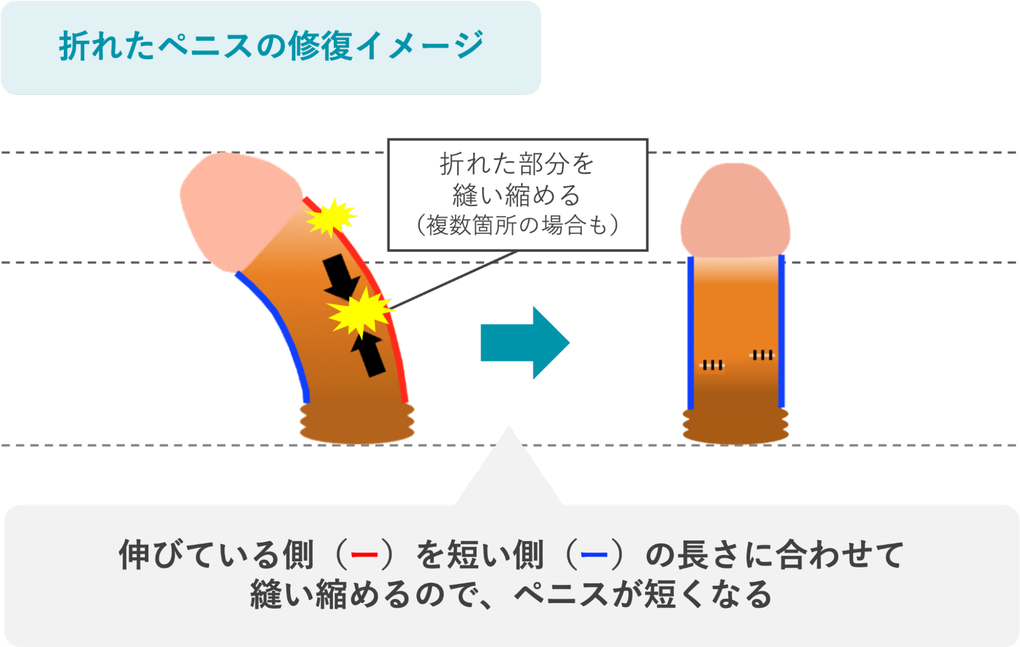 折れたペニスの修復イメージ