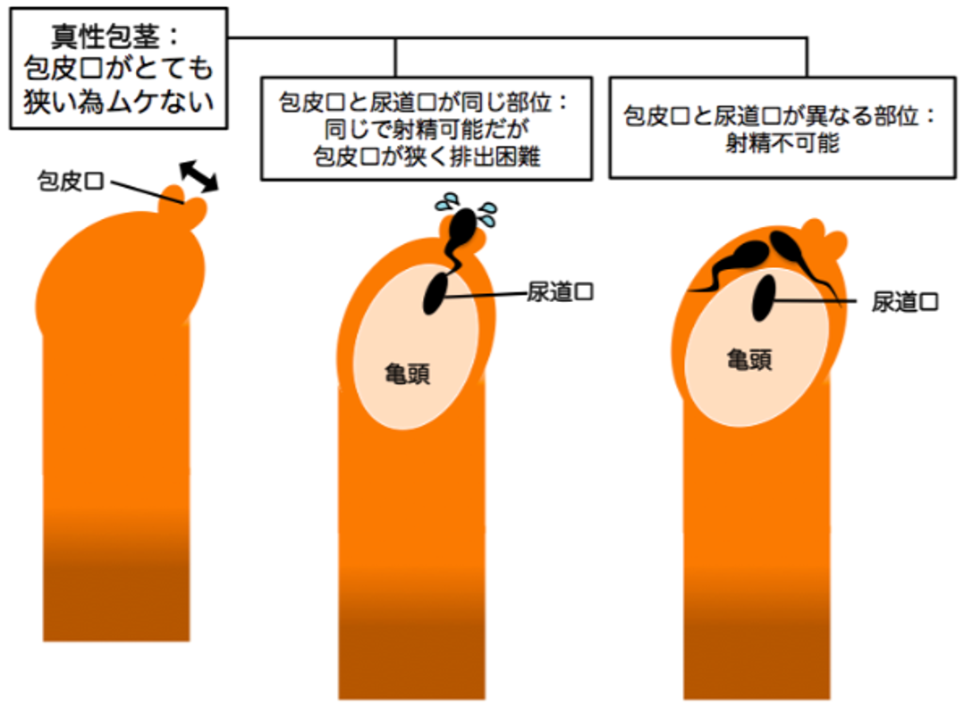 真性包茎による射精のリスク